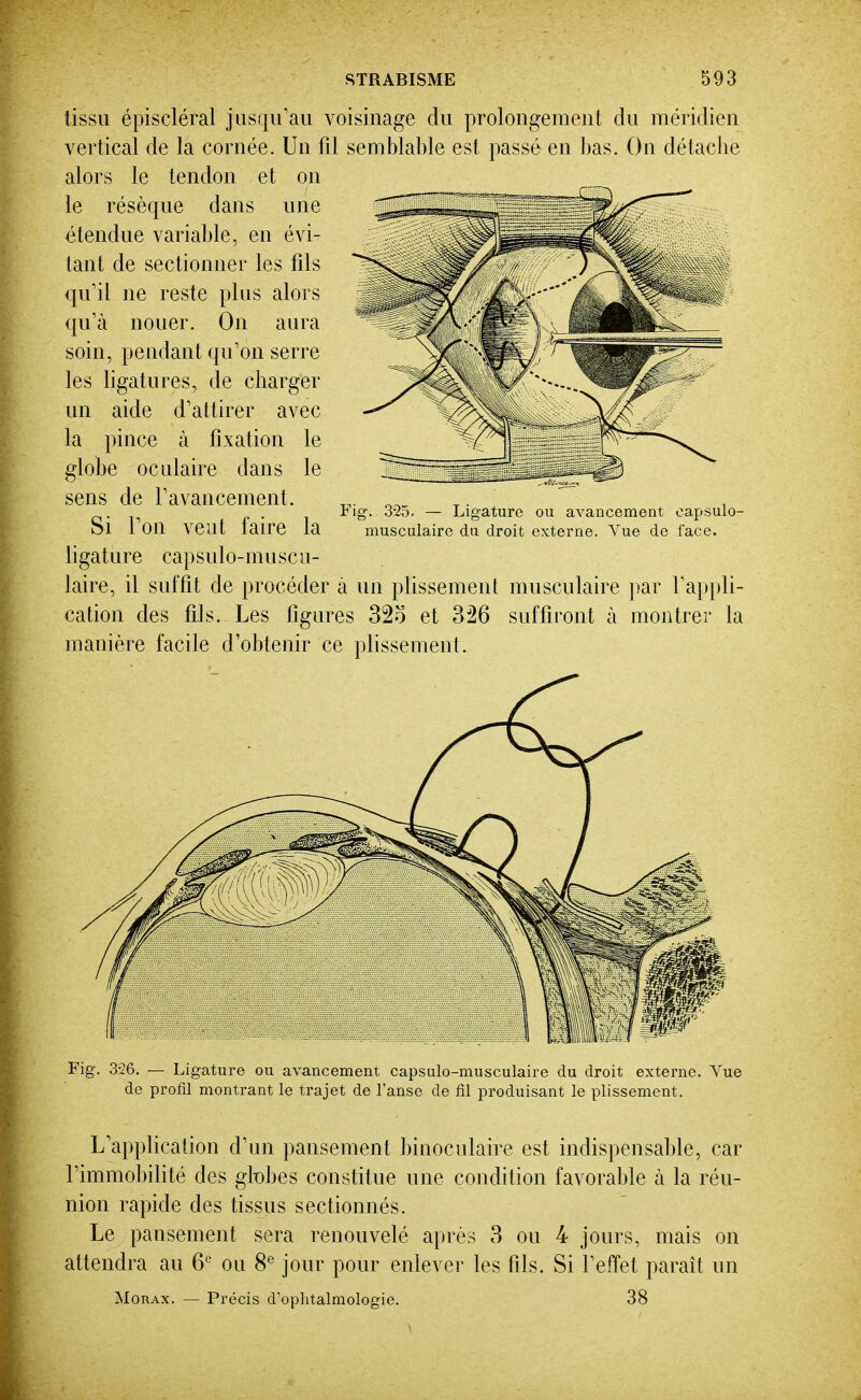 tissu épiscléral jusqu'au voisinage du prolongement du méridien vertical de la cornée. Un fil semblable est passé en ])as. On détache alors le tendon et on le résèque dans une étendue variable, en évi- tant de sectionner les fils qu'il ne reste plus alors qu'à nouer. On aura soin, pendant qu'on serre les ligatures, de charger un aide d'attirer avec la pince à fixation le globe oculaire dans le sens de l'avancement. Si l'on veut faire la ligature capsulo-muscu- laire, il suffit de procéder à un plissement musculaire jiar l'appli- cation des fils. Les figures 32o et 326 suffiront à montrer la manière facile d'obtenir ce plissement. Fig. 3-25. — Ligature ou avancement oapsulo- musculairc du droit externe. Vue de face. Fig. 3-26. — Ligature ou avancement capsulo-musculaire du droit externe. Vue de profil montrant le trajet de l'anse de fil produisant le plissement. L'application d'un pansement binoculaire est indispensable, car l'immobilité des glnbes constitue une condition favora1)le à la réu- nion rapide des tissiis sectionnés. Le pansement sera renouvelé après 3 ou 4 jours, mais on attendra au ou 8^ jour pour enlever les fils. Si l'effet paraît un MoRAx. — Précis d'oplitalmologie. 38 Èt