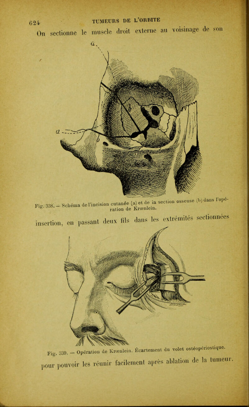 On sectionne le muscle droit externe an voisinage de son a. inserlion, eu passant deux fils dans les extrémités sectionnées du volet ostéopériostique. 339. _ Opération de KrœDleia. Ecartement les réunir facilemeni après ablation de la tumeur pour pouvoir