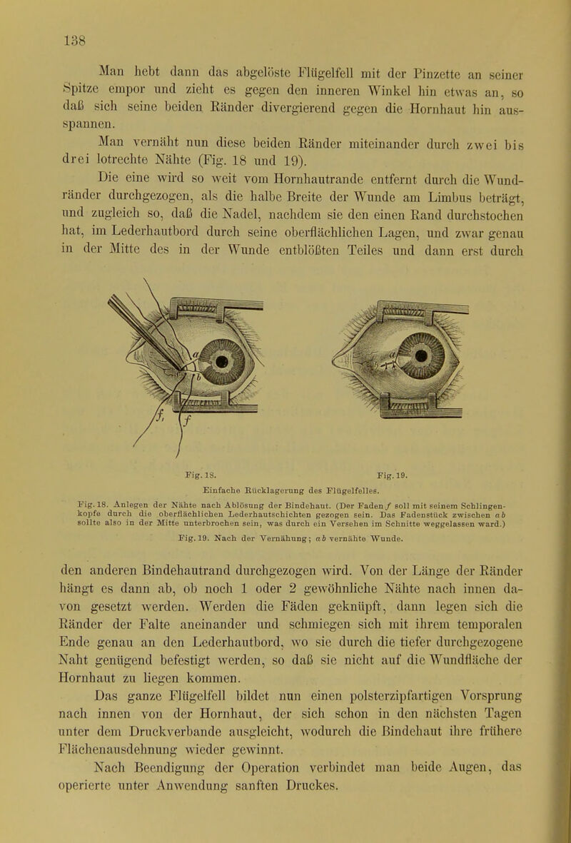 Man hebt dann das abgelöste Flügelfell mit der Pinzette an seiner Spitze empor und zieht es gegen den inneren Winkel hin etwas an, so daß sich seine beiden Ränder divergierend gegen die Hornhaut hin aus- spannen. Man vernäht nun diese beiden Ränder miteinander durch zwei bis drei lotrechte Nähte (Fig. 18 und 19). Die eine wird so weit vom Hornhautrande entfernt durch die Wund- ränder durchgezogen, als die halbe Breite der Wunde am Limbus beträgt, und zugleich so, daß die Nadel, nachdem sie den einen Rand durchstochen hat, im Lederhautbord durch seine oberflächlichen Lagen, und zwar genau in der Mitte des in der Wunde entblößten Teiles und dann erst durch Fig. 18. Anlegen der Nähte nach Ablösung der Bindehaut. (Der Faden / soll mit seinem Schlingen- kopfe durch die oberflächlichen Lederhautschichten gezogen sein. Das Fadenstück zwischen ab sollte also in der Mitte unterbrochen sein, was durch ein Versehen im Schnitte weggelassen ward.) Fig.19. Nach der Vernähung; ab vernähte Wunde. den anderen Bindehautrand durchgezogen wird. Von der Länge der Ränder hängt es dann ab, ob noch 1 oder 2 gewöhnliche Nähte nach innen da- von gesetzt werden. Werden die Fäden geknüpft, dann legen sich die Ränder der Falte aneinander und schmiegen sich mit ihrem temporalen Ende genau an den Lederhautbord, wo sie durch die tiefer durchgezogene Naht genügend befestigt werden, so daß sie nicht auf die Wundfläche der Hornhaut zu liegen kommen. Das ganze Flügelfell bildet nun einen polsterzipfartigen Vorsprung nach innen von der Hornhaut, der sich schon in den nächsten Tagen unter dem Druckverbande ausgleicht, wodurch die Bindehaut ihre frühere Flächenausdehnung wieder gewinnt. Nach Beendigung der Operation verbindet man beide Augen, das operierte unter Anwendung sanften Druckes.