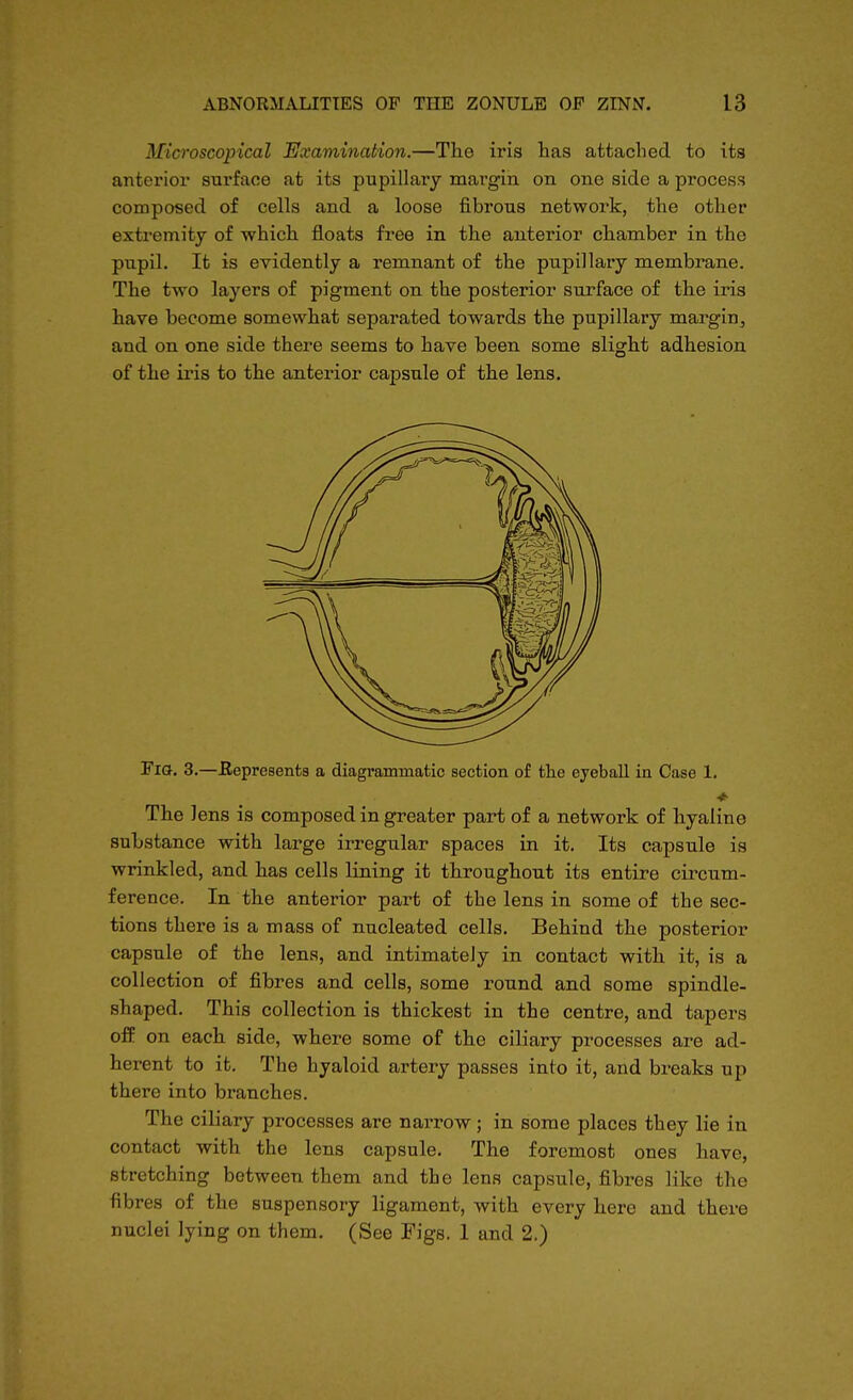 Mid'oscopical Examination.—The iris has attached to its anterior surface at its pupillary margin on one side a process composed of cells and a loose fibrous network, the other extremity of which floats free in the anterior chamber in the pupil. It is evidently a remnant of the pupillary membrane. The two layers of pigment on the posterior surface of the iris have become somewhat separated towards the pupillary margin, and on one side there seems to have been some slight adhesion of the iris to the anterior capsule of the lens. FiQ. 3.—Eepresents a diagrammatic section of the eyeball in Case 1. The lens is composed in greater part of a network of hyaline substance with large irregular spaces in it. Its capsule is wrinkled, and has cells lining it throughout its entire circum- ference. In the anterior part of the lens in some of the sec- tions there is a mass of nucleated cells. Behind the posterior capsule of the lens, and intimately in contact with it, is a collection of fibres and cells, some round and some spindle- shaped. This collection is thickest in the centre, and tapers off on each side, where some of the ciliary processes are ad- herent to it. The hyaloid artery passes into it, and breaks up there into branches. The ciliary processes are narrow; in some places they lie in contact with the lens capsule. The foremost ones have, stretching between them and the lens capsule, fibres like the fibres of the suspensory ligament, with every here and there nuclei lying on them. (See Figs. 1 and 2.)