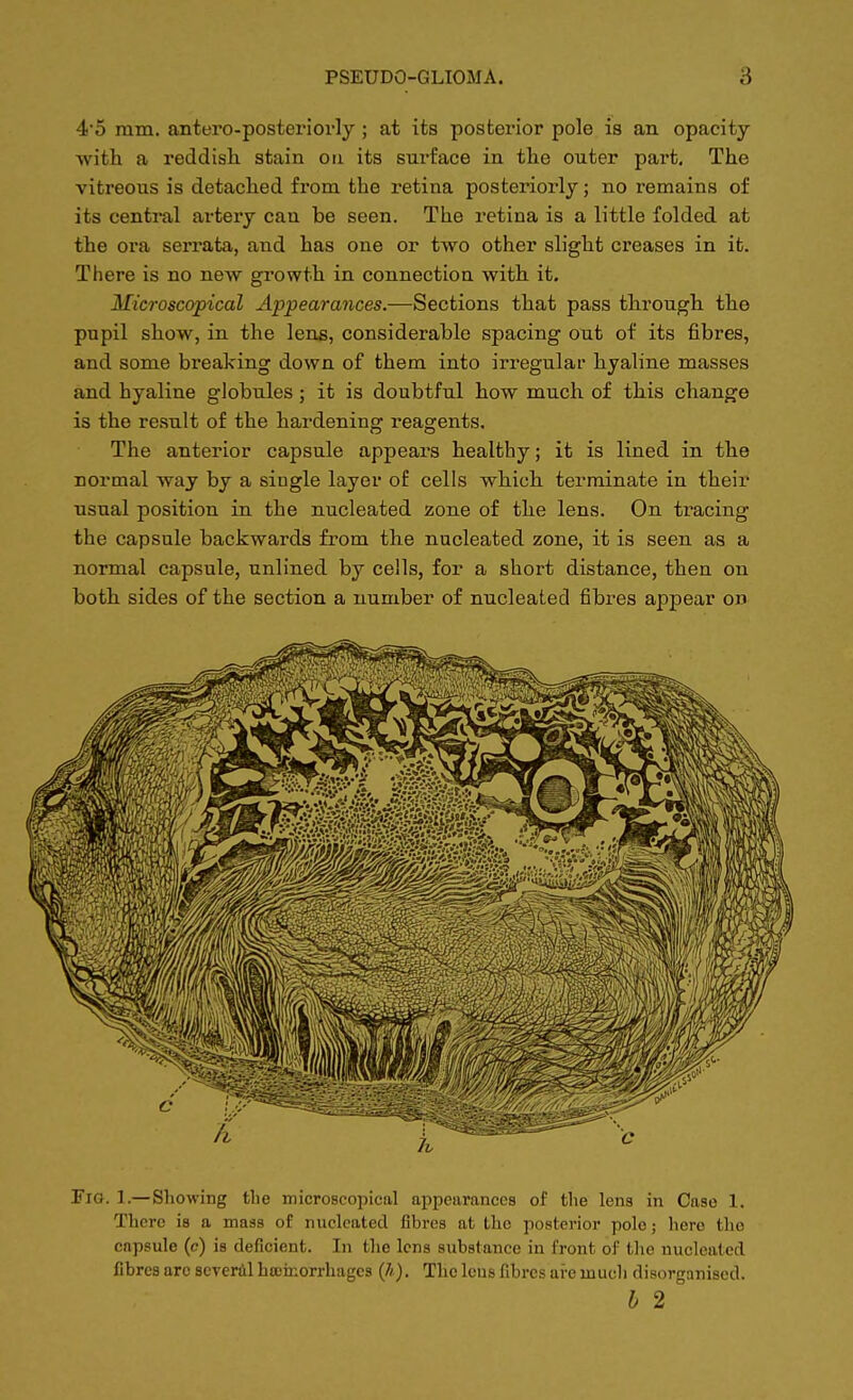 4-5 mm. antero-posteriorly; at its posterior pole is an opacity -with a reddish stain oti its surface in the outer part. The vitreous is detached from the retina posteriorly; no remains of its central artery can be seen. The retina is a little folded at the ora serrata, and has one or two other slight creases in it. There is no new growth in connection with it. Microscopical Appearances.—Sections that pass through the pupil show, in the lens, considerable spacing out of its fibres, and some breaking down of them into irregular hyaline masses and hyaline globules ; it is doubtful how much of this change is the result of the hardening reagents. The anterior capsule appears healthy; it is lined in the normal way by a siugle layer of cells which terminate in their usual position in the nucleated zone of the lens. On tracing the capsule backwards from the nucleated zone, it is seen as a normal capsule, unlined by cells, for a short distance, then on both sides of the section a number of nucleated fibres appear on Fig. 1.— Showing the microscopical appearances of the lens in Case 1. There is a mass of nucleated fibres at the posterior polo; hero the capsule (c) is deficient. In the lens substance in front of the nucleated fibres arc several haemorrhages (//). The lens fibres are much disorganised. b 2