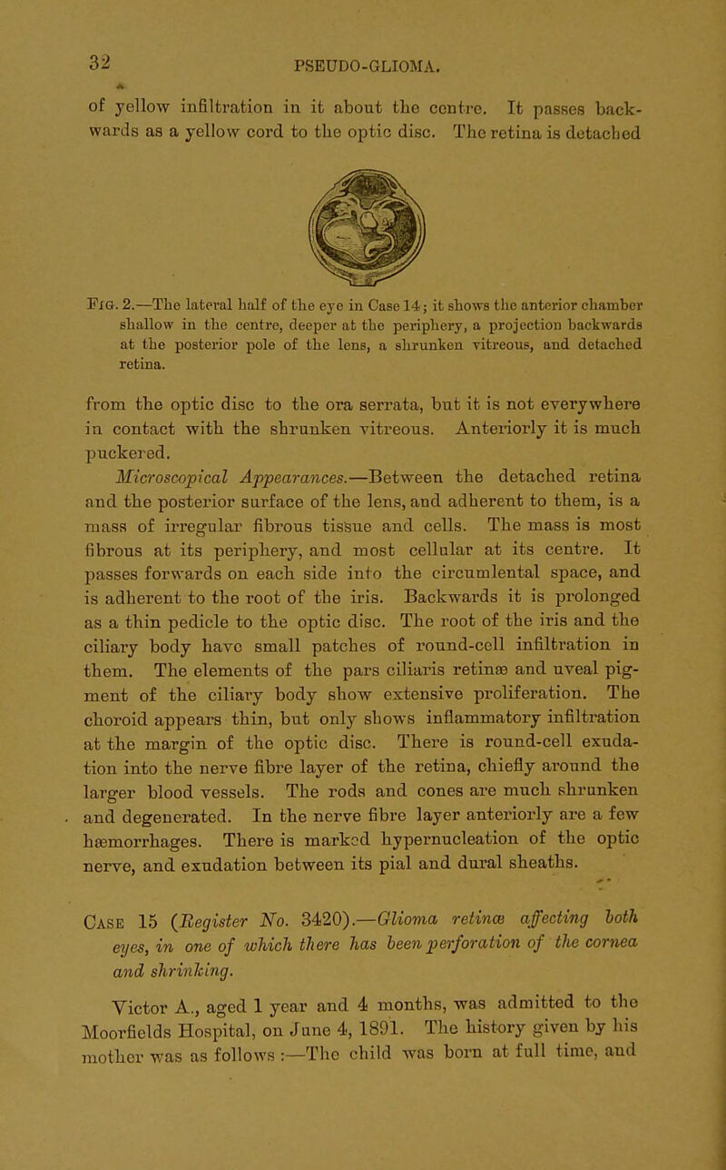 A of yellow infiltration in it about the centre. It passes back- wards as a yellow cord to the optic disc. The retina is detached Fig. 2.—The lateral half of tlie eye in Case 14; it shows the anterior chamber shallow in the centre, deeper at the periphery, a projection backwards at the posterior pole of the lens, a shrunken yitreous, and detached retina. from the optic disc to the ora serrata, but it is not everywhere in contact with the shrunken vitreous. Anteriorly it is much puckered. Microscopical Appearances.—Between the detached retina aud the posterior surface of the lens, aud adherent to them, is a mass of irregular fibrous tissue and cells. The mass is most fibrous at its periphery, and most cellular at its centre. It passes forwards on each side into the circumlental space, and is adherent to the root of the iris. Backwards it is prolonged as a thin pedicle to the optic disc. The root of the iris and the ciliary body have small patches of round-cell infiltration in them. The elements of the pars ciliaris retinas and uveal pig- ment of the ciliary body show extensive proliferation. The choroid appears thin, but only shows inflammatory infiltration at the margin of the optic disc. There is round-cell exuda- tion into the nerve fibre layer of the retina, chiefly around the larger blood vessels. The rods and cones are much shrunken and degenerated. In the nerve fibre layer anteriorly are a few haemorrhages. There is marked hypernucleation of the optic nerve, and exudation between its pial and dural sheaths. Case 15 (Register No. 3420).—Glioma retina) affecting both eyes, in one of which there has been perforation of the cornea and shrinking. Victor A., aged 1 year and 4 months, was admitted to the Moorfields Hospital, on June 4, 1891. The history given by his mother was as follows :—The child was born at full time, and