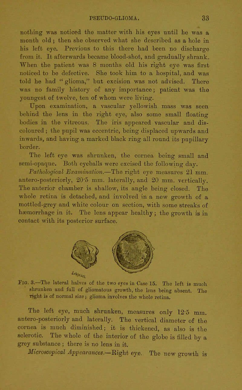 nothing was noticed the matter with his eyes until he was a month old ; then she observed what she described as a hole in his left eye. Previous to this there had been no discharge from it. It afterwards became blood-shot, and gradually shrank. When the patient was 8 months old his right eye was first noticed to be defective. She took him to a hospital, and was told he had  glioma, but excision was not advised. There was no family history oil any importance; patient was the youngest of twelve, ten of whom were living. Upon examination, a vascular yellowish mass was seen behind the lens in the right eye, also some small floating bodies in the vitreous. The iris appeared vascular and dis- coloured ; the pupil was eccentric, being displaced upwards and inwards, and having a marked black ring all round its pupillary border. The left eye was shrunken, the cornea being small and semi-opaque. Both eyeballs were excised the following day. Pathological Examination.—The right eye measures 21 mm. antero-posteriorly, 205 mm. laterally, and 20 mm. vertically. The anterior chamber is shallow, its angle being closed. The whole retina is detached, and involved in a new growth of a mottled-grey and white colour on section, with some streaks of haemorrhage in it. The lens appear healthy; the growth is in contact with its posterior surface. Fig. 3.—The lateral halves of the two eyes in Case 15. The left is much shrunken and full of gliomatous growth, the lens being absent. The right is of normal size; glioma involves the whole retina. The left eye, much shrunken, measures only 12-5 mm. antero-posteriorly and laterally. The vertical diameter of the cornea is much diminished; it is thickened, as also is the sclerotic. The whole of the interior of the globe is filled by a grey substance ; there is no lens in it. Microscopical Appearances.—Right eye. The new growth is