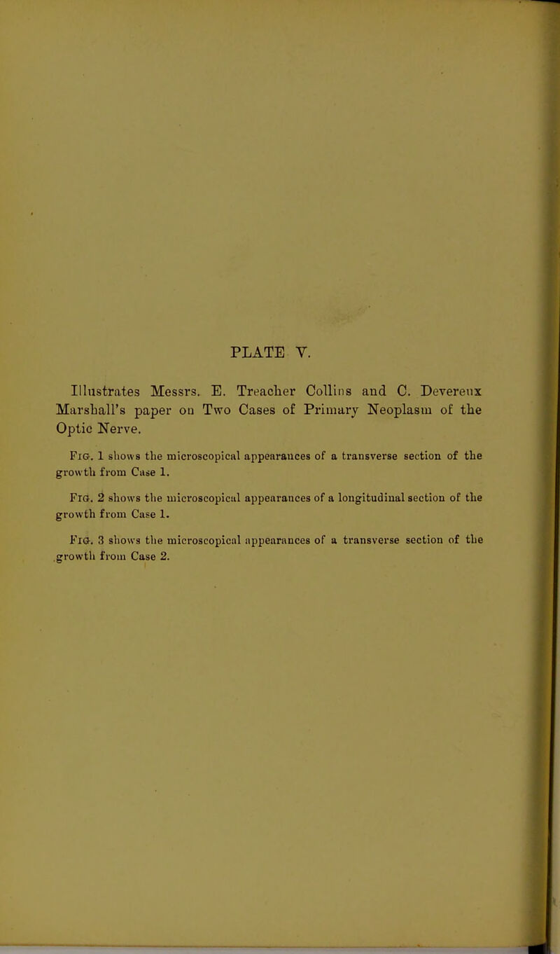 PLATE V. Illustrates Messrs. E. Treacher Collins and C. Deverenx Marshall's paper on Two Cases of Priiiiary Neoplasm o£ the Optic Nerve. Fig. 1 shows the microscopical appearances of a transverse section of tlie growtli from Case 1. Fro. 2 shows the uiicroscopical appearances of a longitudinal section of the growth from Case 1. Fig. 3 sliows tlie microscopical appearances of a transverse section of the .growth from Case 2.