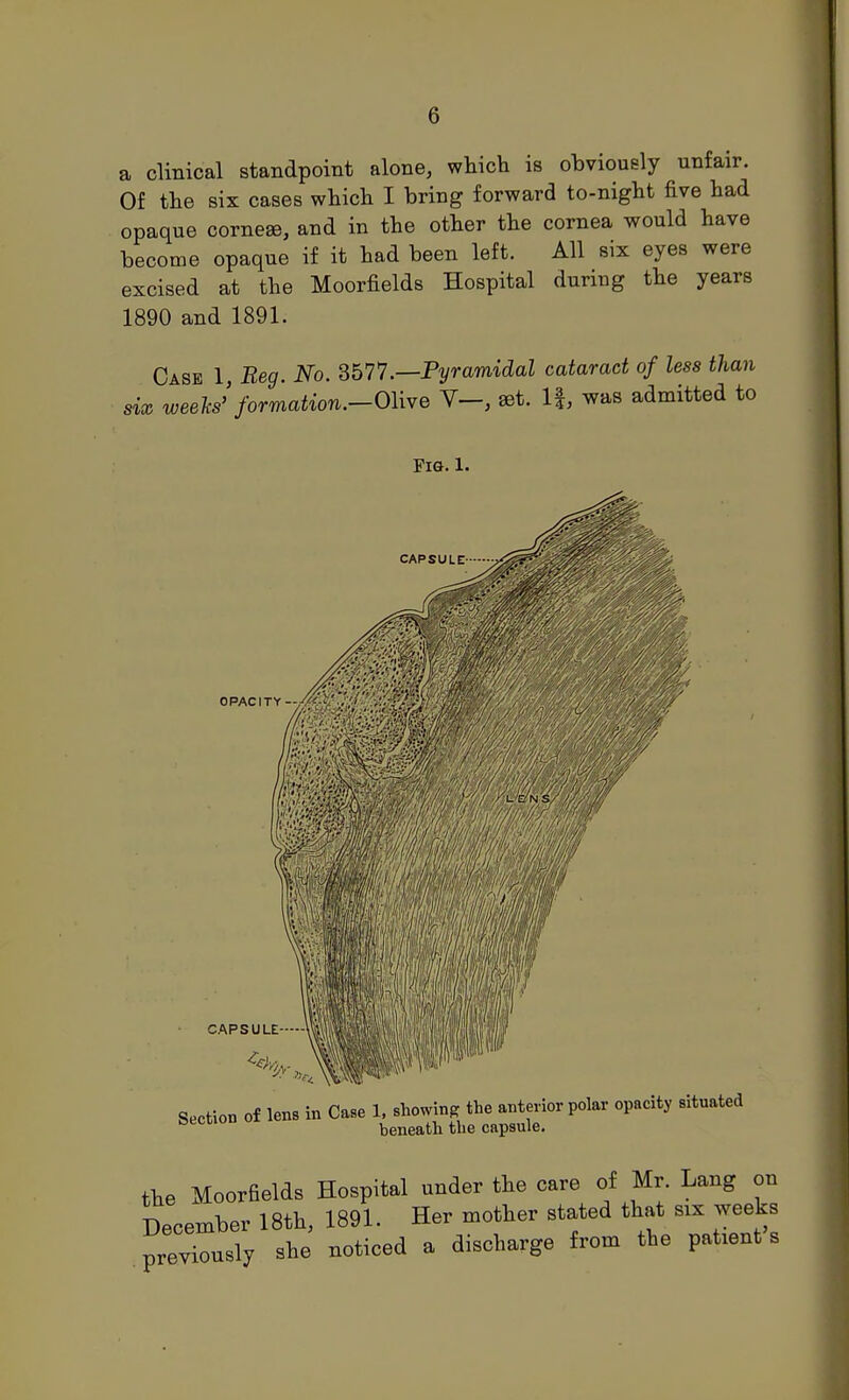 a clinical standpoint alone, which is obviously unfair. Of the six cases which I bring forward to-night five had opaque cornese, and in the other the cornea would have become opaque if it had been left. All six eyes were excised at the Moorfields Hospital during the years 1890 and 1891. Case 1 Reg. No. db7l.—Pyramidal cataract of less than six weeks'formation.-OMve set. If, was admitted to OPACITY- Fig. 1. CAPSULE CAPSULE Section of lens in Case 1. showing the anterior polar opacity situated beneatli the capsule. the Moorfields Hospital under the care of Mr. Lang on December 18th, 1891. Her mother stated that six weeks prevTusly she noticed a discharge from the patient's