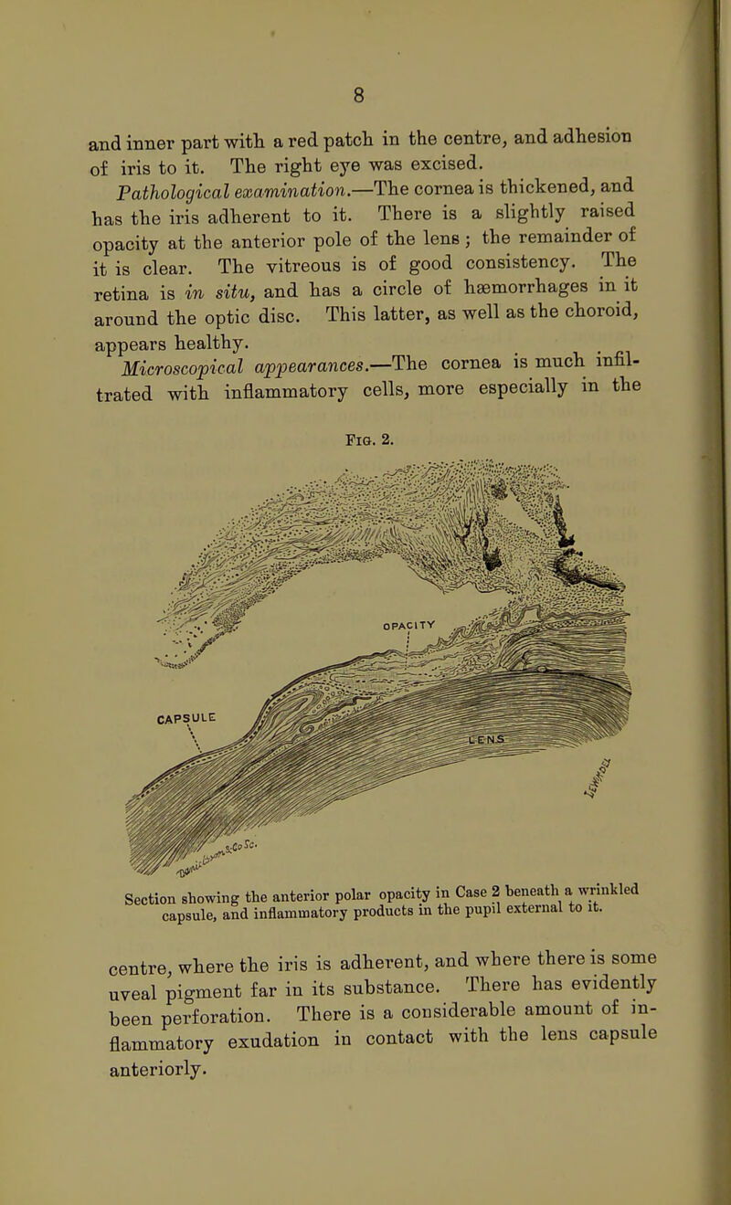 and inner part witli a red patcli in the centre, and adhesion of iris to it. The right eye was excised. Pathological examination.—The cornea is thickened, and has the iris adherent to it. There is a slightly raised opacity at the anterior pole of the lens; the remainder of it is clear. The vitreous is of good consistency. The retina is in situ, and has a circle of haemorrhages in it around the optic disc. This latter, as well as the choroid, appears healthy. Microscopical appearances.—The cornea is much infil- trated with inflammatory cells, more especially in the Fig. 2. centre, where the iris is adherent, and where there is some uveal pigment far in its substance. There has evidently been perforation. There is a considerable amount of in- flammatory exudation in contact with the lens capsule anteriorly.