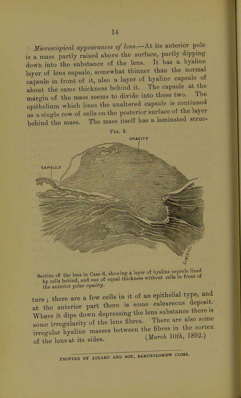 Microscopical appearances of lens—At its anterior pole is a mass partly raised above tlie surface, partly dipping down into the substance of tbe lens. It has a hyaline layer of lens capsule, somewhat thinner than the normal capsule in front of it, also a layer of hyaline capsule of about the same thickness behind it. The capsule at the margin of the mass seems to divide into these two. The epithelium which lines the unaltered capsule is continued as a single row of cells on the posterior surface of the layer behind the mass. The mass itself has a laminated struc Fig. 5. oPAciTr the anterior polar opacity. ture ; there are a few cells in it of an epithelial type, and at the anterior part there is some calcareous deposit