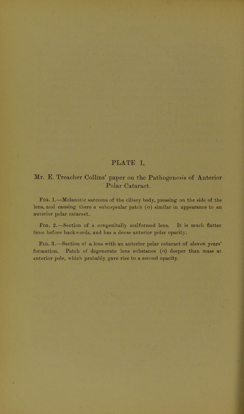 PLATE I. Mr. E. Treacher Collins' paper on the Pathogenesis of Anterior Polar Cataract. Fig. 1.—Melanotic sarcoma of the ciliary body, pressing on tlie side of the lens, and causing tliere a subcapsular patch (o) similar in appearance to an anterior polar cataract. Pig. 2.—Section of a congenitally malformed lens. It is much flatter from before backwards, and has a dense anterior polar opacity. Fig. 3.—Section of a lens with an anterior polar cataract of eleven years' formation. Patch of degenerate lens substance (o) deeper than mass at anterior pole, which probably gave rise to a second opacitj'.