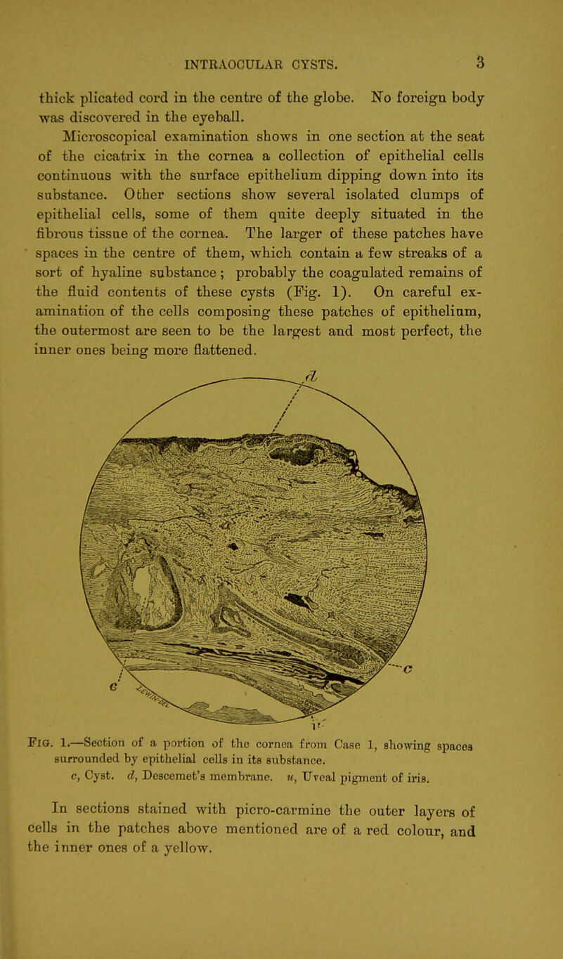 thick plicated cord in the centre of the globe. No foreign body- was discovered in the eyeball. Microscopical examination shows in one section at the seat of the cicatrix in the cornea a collection of epithelial cells continuous with the surface epithelium dipping down into its substance. Other sections show several isolated clumps of epithelial cells, some of them quite deeply situated in the fibrous tissue of the cornea. The larger of these patches have spaces in the centre of them, which contain a few streaks of a sort of hyaline substance ; probably the coagulated remains of the fluid contents of these cysts (Fig. 1). On careful ex- amination of the cells composing these patches of epithelium, the outermost are seen to be the largest and most perfect, the inner ones being more flattened.  v- FiG. L—Section of a portion of the cornea from Case 1, showing spaces surrounded by epithelial cells in its substance. c, Cyst, d, Descemet's membrane. «, Uveal pigment of iris. In sections stained with picro-carmine the outer layers of cells in the patches above mentioned are of a red colour, and the inner ones of a yellow.