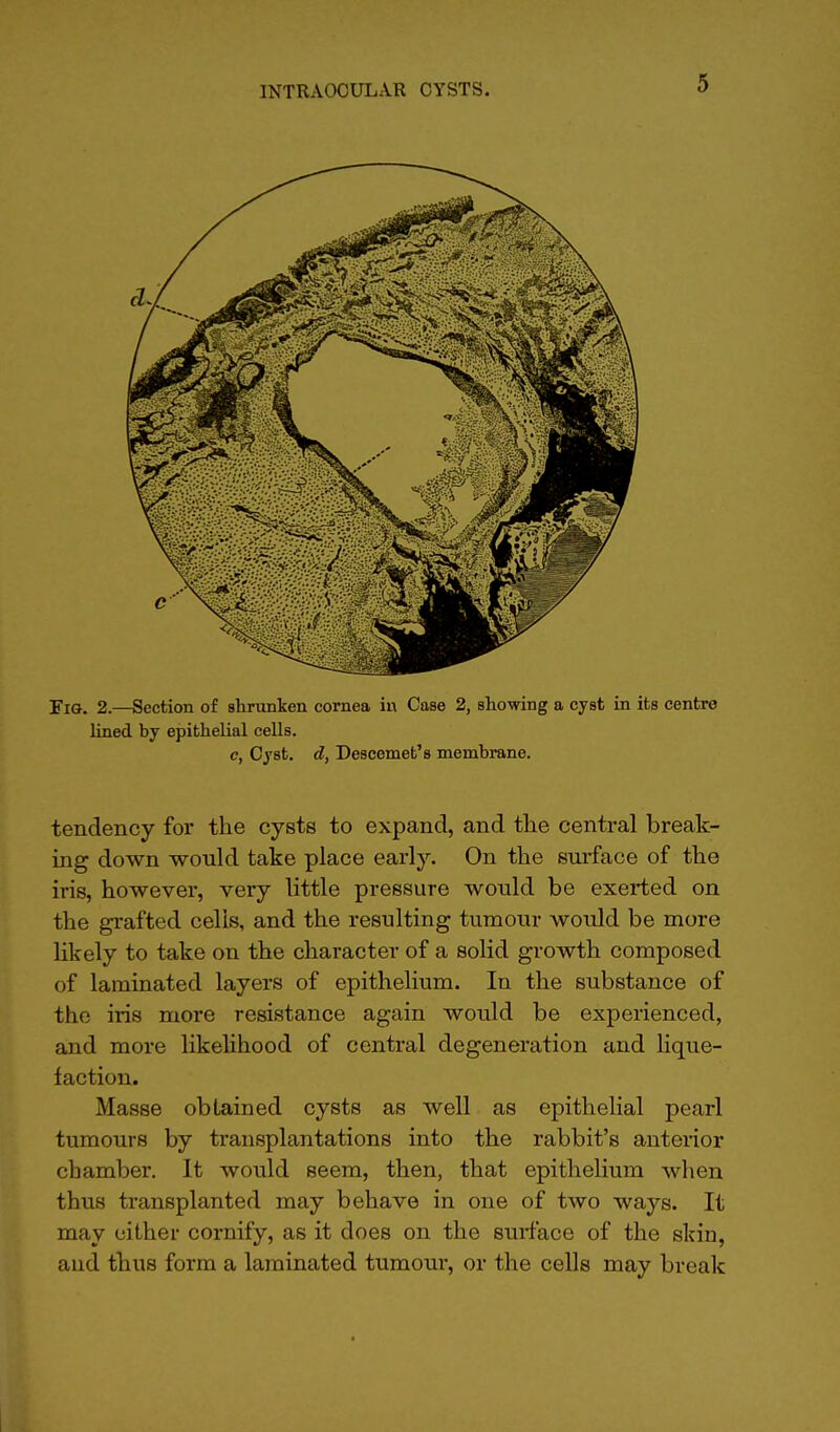 Fig. 2.—Section of shrunken cornea in Case 2, showing a cyst in its centre lined by epithelial cells. c, Cyst, d, Descemet's membrane. tendency for the cysts to expand, and the central break- ing down would take place early. On the surface of the iris, however, very little pressure would be exerted on the grafted cells, and the resulting tumour would be more likely to take on the character of a solid growth composed of laminated layers of epithelium. In the substance of the iris more resistance again would be experienced, and more likelihood of central degeneration and lique- faction. Masse obtained cysts as well as epithelial pearl tumours by transplantations into the rabbit's anterior chamber. It would seem, then, that epithelium when thus transplanted may behave in one of two ways. It may either cornify, as it does on the surface of the skin, and thus form a laminated tumour, or the cells may break