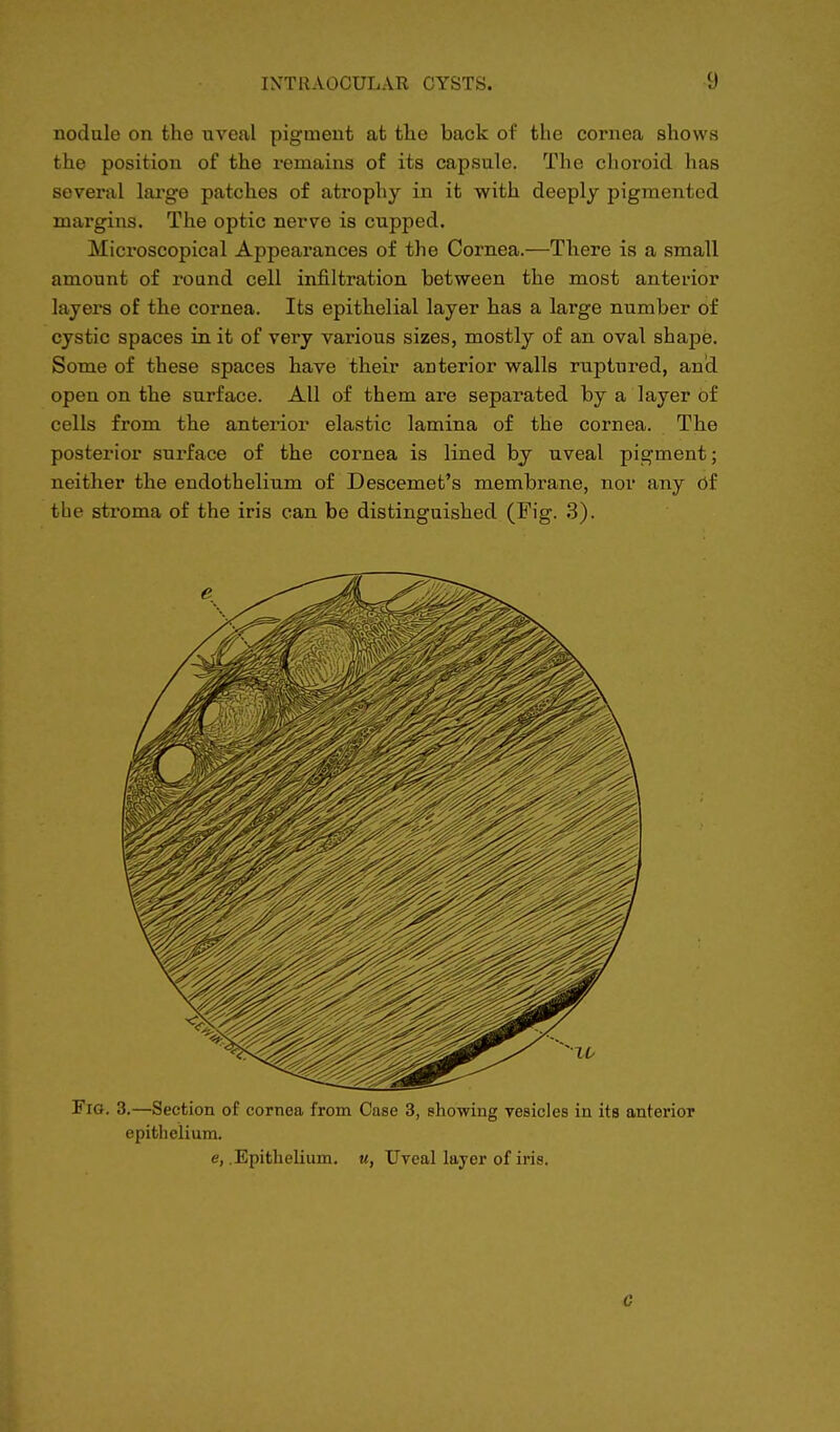 nodule on the uveal pigment at the back of the cornea shows the position of the remains of its capsule. The choroid has several large patches of atrophy in it with deeply pigmented margins. The optic nerve is cupped. Microscopical Appearances of the Cornea.—There is a small amount of round cell infiltration between the most anterior layers of the cornea. Its epithelial layer has a large number of cystic spaces in it of very various sizes, mostly of an oval shape. Some of these spaces have their anterior walls ruptured, and open on the surface. All of them are separated by a layer of cells from the anterior elastic lamina of the cornea. The posterior surface of the cornea is lined by uveal pigment; neither the endothelium of Descemet's membrane, nor any of the stroma of the iris can be distinguished (Fig. 3). Fig. 3.—Section of cornea from Case 3, showing resides in its anterior epithelium. e, .Epithelium, u, Uveal layer of iris. C