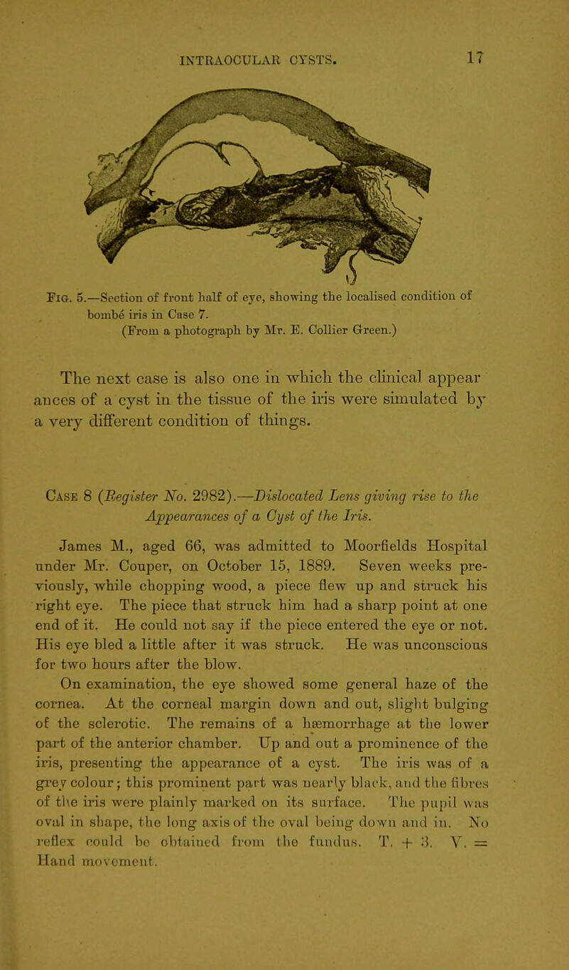 Fig. 5.—Section of front half of eye, showing the localised condition of hombe iris in Case 7. (From a photograph by Mr. E. Collier Green.) The next case is also one in which the clinical appear auces of a cyst in the tissue of the iris were simulated by a very different condition of things. Case 8 (Register No. 2982).—Dislocated Lens giving rise to the Appearances of a Cyst of the Iris. James M., aged 66, was admitted to Moorfields Hospital under Mr. Couper, on October 15, 1889. Seven weeks pre- viously, while chopping wood, a piece flew up and struck his right eye. The piece that struck him had a sharp point at one end of it. He could not say if the piece entered the eye or not. His eye bled a little after it was struck. He was unconscious for two hours after the blow. On examination, the eye showed some general haze of the cornea. At the corneal margin down and out, slight bulging of the sclerotic. The remains of a haemorrhage at the lower part of the anterior chamber. Up and out a prominence of the iris, presenting the appearance of a cyst. The iris was of a grey colour; this prominent part was nearly black, and the fibres of the iris were plainly marked on its surface. The pupil was oval in shape, the long axis of the oval being down and in. No reflex could be obtained from the fundus. T. + 3. V. = Hand movement.