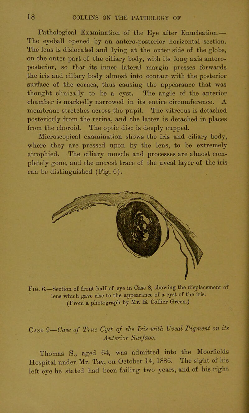 Pathological Examination of the Eye after Enucleation.— The eyeball opened by an antero-posterior horizontal section. The lens is dislocated and lying at the outer side of the globe, on the outer part of the ciliary body, with its long axis antero- posterior, so that its inner lateral margin presses forwards the iris and ciliary body almost into contact with the posterior surface of the cornea, thus causing the appearance that was thought clinically to be a cyst. The angle of the anterior chamber is markedly narrowed in its entire circumference. A membrane stretches across the pupil. The vitreous is detached posteriorly from the retina, and the latter is detached in places from the choroid. The optic disc is deeply cupped. Microscopical examination shows the iris and ciliary body, where they are pressed upon by the lens, to be extremely atrophied. The ciliary muscle and processes are almost com- pletely gone, and the merest trace of the uveal layer of the iris can be distinguished (Fig. 6). Fig. 6—Section of front half of eye in Case 8, showing the displacement of lens which gave rise to the appearance of a cyst of the iris. (From a photograph by Mr. E. Collier Green.) Case 9—Case of True Cyst of the Iris with Uveal Pigment on its Anterior Surface. Thomas S., aged 64, was admitted into the Moorfields Hospital under Mr. Tay, on October 14, 1886. The sight of his left eye he stated had been failing two years, and of his right