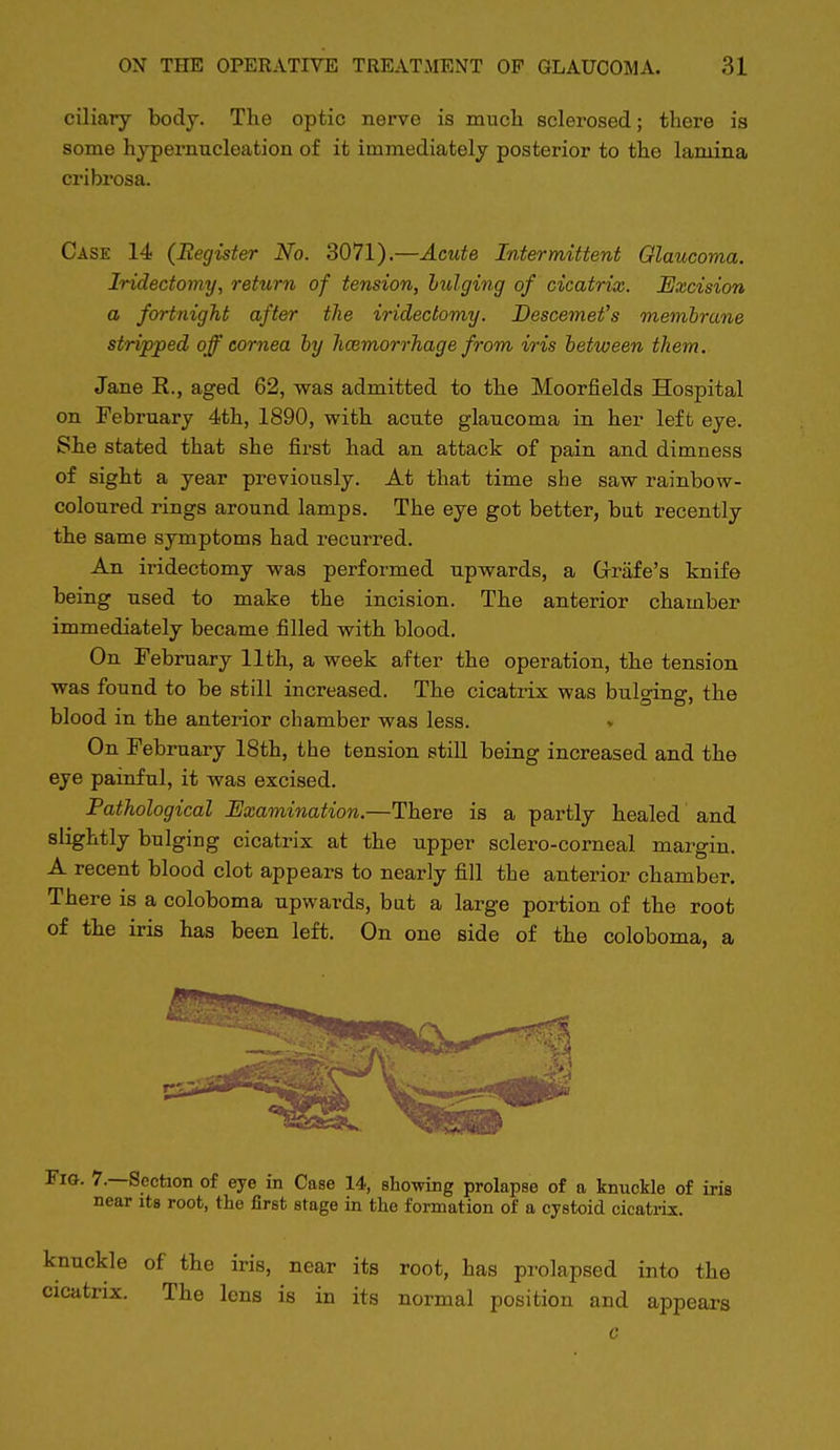 ciliary body. The optic nerve is mucli sclerosed; there is some hypernucleation of it immediately posterior to the lamina cribrosa. Case 14 (Eegister No. 3071).—Acute Intermittent Glaucovia. Iridectomy, return of tension, bulging of cicatrix. Excision a fortnight after the iridectomy. Descemefs membrane stripped off cornea by hcemorrJiage from iris between them. Jane R., aged 62, was admitted to the Moorfields Hospital on February 4th, 1890, with acute glaucoma in her left eye. She stated that she first had an attack of pain and dimness of sight a year previously. At that time she saw rainbow- coloured rings around lamps. The eye got better, but recently the same symptoms had recurred. An iridectomy was performed upwards, a Grrafe's knife being used to make the incision. The anterior chamber immediately became filled with blood. On February 11th, a week after the operation, the tension was found to be still increased. The cicatrix was bulging, the blood in the anterior chamber was less. * On February 18th, the tension still being increased and the eye painful, it was excised. Pathological Examination.—There is a partly healed and slightly bulging cicatrix at the upper sclero-corneal margin. A recent blood clot appears to nearly fill the anterior chamber. There is a coloboma upwards, bat a large portion of the root of the iris has been left. On one side of the coloboma, a Fig. 7.—Section of eye in Case 14, showing prolapse of a knuckle of iris near its root, the first stage in the formation of a cystoid cicatrix. knuckle of the iris, near its root, has prolapsed into the cicatrix. The lens is in its normal position and appears