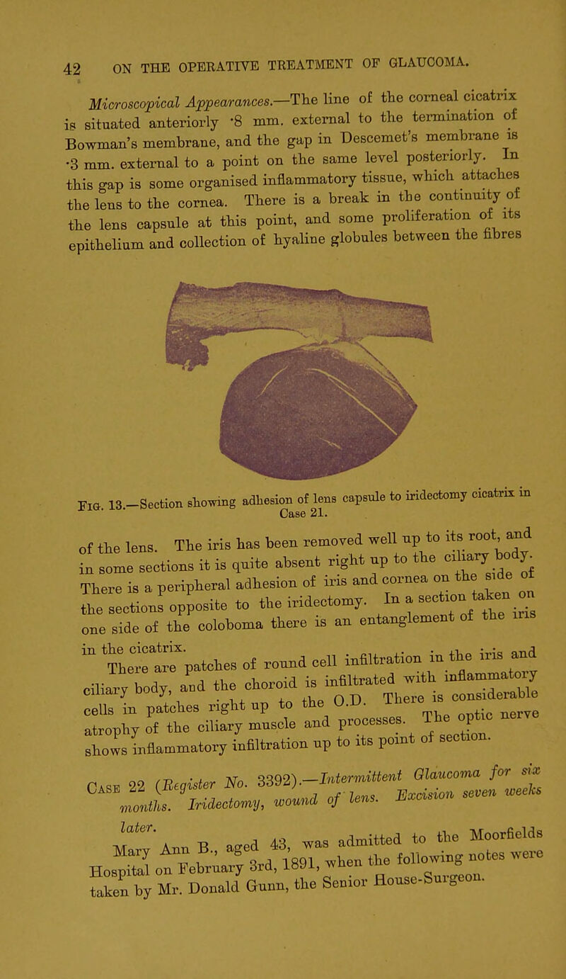 It Microscopical Appearances.—The line of the corneal cicatrix is situated anteriorly '8 mm. external to the termination of Bowman's membrane, and the gap in Descemet's membrane is •3 mm. external to a point on the same level posteriorly. In this gap is some organised inflammatory tissue, which attaches the lens to the cornea. There is a break in the contmmty ot the lens capsule at this point, and some proliferation of its epithelium and collection of hyaline globules between the fibres Fia 13.-Section stowing adliesion of lens capsule to iridectomy cicatrix in Case 21. of the lens. The iris has been removed well np to its root a^d in some sections it is ,uite absent right up to the - -ry body^ There is a peripheral adhesion of iris and eornea on the side ot the ctions opposite «° the irideetoray. one side of the coloboma there is an entanglement of the ms Thelrarpatches of rou^d cell inffltration in the iris and Cili2Tody, and the choroid is infiltrated with -^-'-^-^^^ * in p^aes right up to the O.D. T---—^ atrophy of the ciliary muscle and processes The optic nerve Ihows Inflammatory infiltration up to its point of section. • t Mr. qqq2^ —Intermittent Olaucoma for six Case 22 iEeg^ster No. 3392). ^^^j,, months. Iridectomy, wound of lens. H^xci^ion T''' A.. B a^ed 43 was admitted to the Moorfields HospS otTeb^;rytd, iW, .hen the ^ere taken by Mr. Donald Gunn, the Senior House-Suigeon.