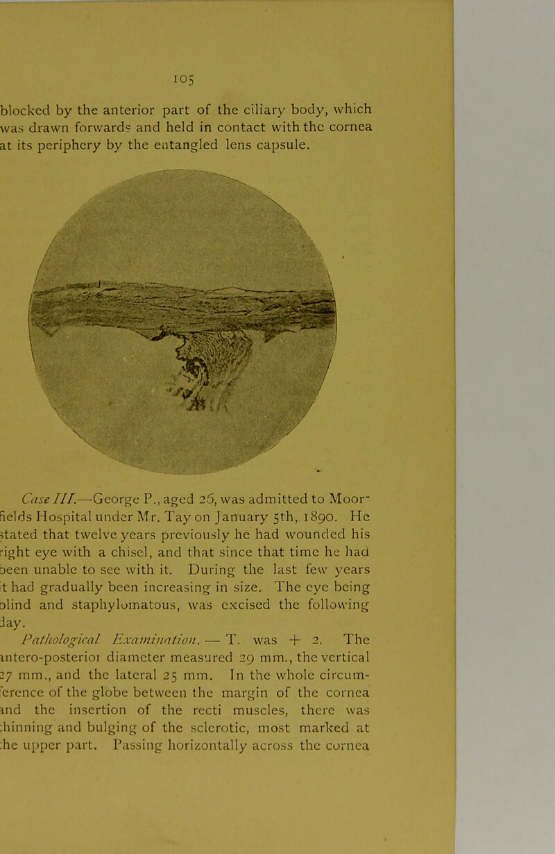 blocked by the anterior part of the ciliary body, which was drawn forwards and held in contact with the cornea at its periphery by the entangled lens capsule. Case III.—George P., aged 26, was admitted to Moor- fields Hospital under Mr. Tay on January 5th, 1890. He stated that twelve years previously he had wounded his -ight eye with a chisel, and that since that time he had Deen unable to see with it. During the last few years t had gradually been increasing in size. The eye being Dlind and staphylumatous, was excised the following day. Pathological Examination. — T. was + 2. The mtero-posterior diameter measured 29 mm., the vertical 27 mm., and the lateral 25 mm. In the whole circum- erence of the globe between the margin of the cornea ind the insertion of the recti muscles, there was :hinning and bulging of the sclerotic, most marked at ;he upper part. Passing horizontally across the cornea