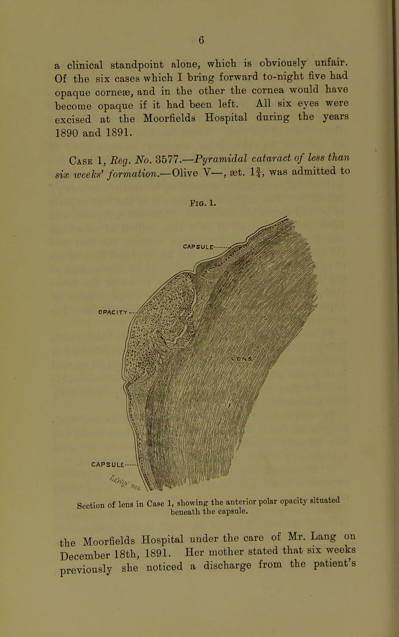 a clinical standpoint alone, wtich is obviously unfair. Of tlie six cases wliicli I bring forward to-nigbt five had opaque cornese, and in the other the cornea would have become opaque if it had been left. All six eyes were excised at the Moorfields Hospital during the years 1890 and 1891. Case 1, Reg. No. 3577.—Pyramidal cataract of less than six iveehs' formation.—Olive V—, eet. 1|, was admitted to riG. 1. Section of lens in Case 1, showing the anterior polar opacity situated beneath the capsule. the Moorfields Hospital under the care of Mr. Lang on December 18th, 1891. Her mother stated that six weeks previously she noticed a discharge from the patient's