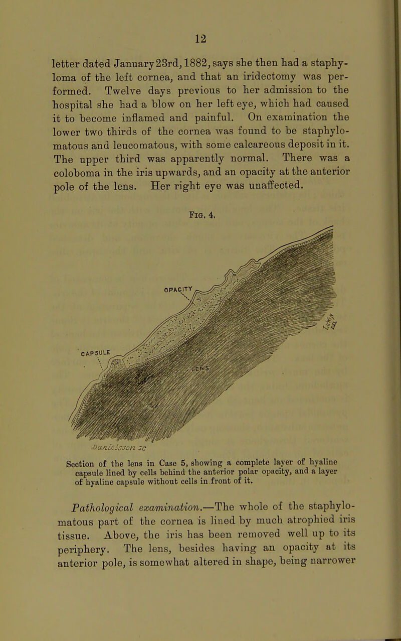 letter dated January 23rd, 1882, says slie then had a staphy- loma of the left cornea, and that an iridectomy was per- formed. Twelve days previous to her admission to the hospital she had a blow on her left eye, which had caused it to become inflamed and painful. On examination the lower two thirds of the cornea was found to be staphylo- matous and leucomatous, with some calcareous deposit in it. The upper third was apparently normal. There was a coloboma in the iris upwards, and an opacity at the anterior pole of the lens. Her right eye was unaffected. Fia. 4. Section of the lens in Case 5, showing a complete layer of hyaline capsule lined by cells behind the anterior polar opacity, and a layer of hyaline capsule without cells in front of it. Pathological examination.—The whole of the staphylo- matous part of the cornea is lined by much atrophied iris tissue. Above, the iris has been removed well up to its periphery. The lens, besides having an opacity at its anterior pole, is somewhat altered in shape, being narrower