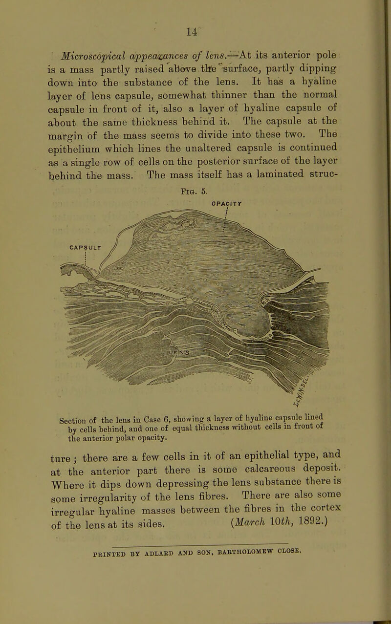 Microscopical appearances of lens.—At its anterior pole is a mass partly raised'above tlte' surface, partly dipping down into the substance of tlie lens. It has a hyaline layer of lens capsule, somewhat thinner than the normal capsule in front of it, also a layer of hyaline capsule of about the same thickness behind it. The capsule at the margin of the mass seems to divide into these two. The epithelium which lines the unaltered capsule is continued as a single row of cells on the posterior surface of the layer behind the mass. The mass itself has a laminated struc- FiG. 5. oPAcijy I Section of the lens in Case 6, showing a layer of hyaline capsule lined by cells behind, and one of equal thickness without cells m front ot the anterior polar opacity. ture; there are a few cells in it of an epithelial type, and at the anterior part there is some calcareous deposit. Where it dips down depressing the lens substance there is some irregularity of the lens fibres. There are also some irregular hyaline masses between the fibres in the cortex of the lens at its sides. {March lOth, 1892.) PEINTBD BY ADLAEP AND SON, BABTHOLOMKW OLOSK.