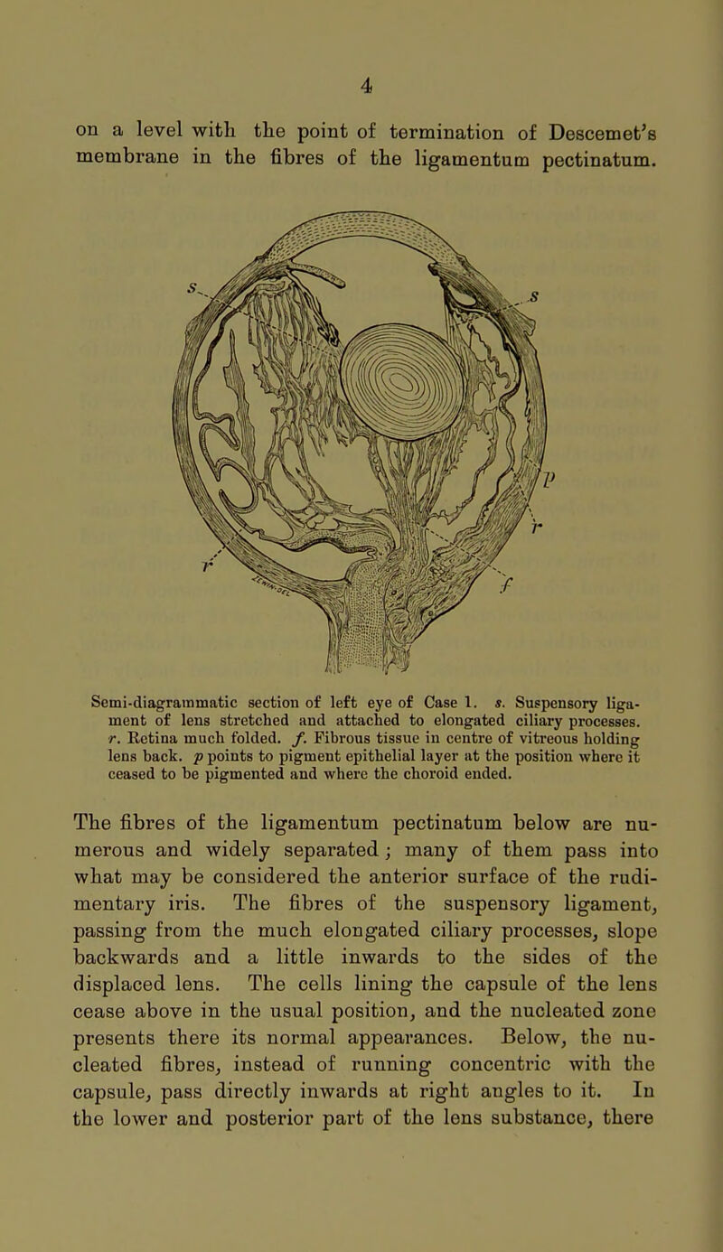 on a level with the point of termination of Descemet's membrane in the fibres of the ligamentum pectinatum. Semi-diagrammatic section of left eye of Case 1. Suspensory liga- ment of lens stretched and attached to elongated ciliary processes. r. Retina much folded, f. Fibrous tissue in centre of vitreous holding lens back, p points to pigment epithelial layer at the position where it ceased to be pigmented and where the choroid ended. The fibres of the ligamentum pectinatum below are nu- merous and widely separated; many of them pass into what may be considered the anterior surface of the rudi- mentary iris. The fibres of the suspensory ligament, passing from the much elongated ciliary processes, slope backwards and a little inwards to the sides of the displaced lens. The cells lining the capsule of the lens cease above in the usual position, and the nucleated zone presents there its normal appearances. Below, the nu- cleated fibres, instead of running concentric with the capsule, pass directly inwards at right angles to it. In the lower and posterior part of the lens substance, there