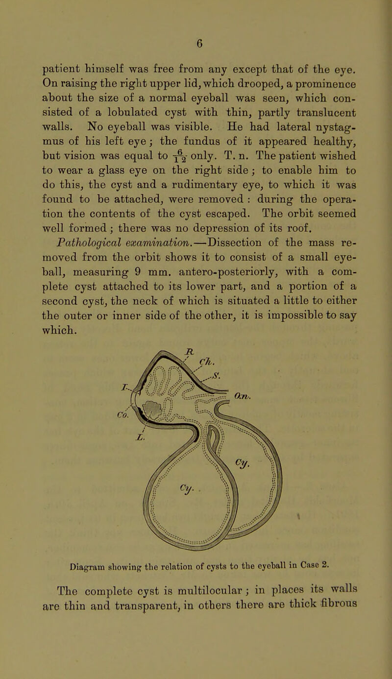 patient himself was free from any except that of the eye. On raising the right upper lid, which drooped, a prominence about the size of a normal eyeball was seen, which con- sisted of a lobulated cyst with thin, partly translucent walls. No eyeball was visible. He had lateral nystag- mus of his left eye; the fundus of it appeared healthy, but vision was equal to -jf^- only. T. n. The patient wished to wear a glass eye on the right side; to enable him to do this, the cyst and a rudimentary eye, to which it was found to be attached, were removed : during the opera- tion the contents of the cyst escaped. The orbit seemed well formed; there was no depression of its roof. Pathological examination.—Dissection of the mass re- moved from the orbit shows it to consist of a small eye- ball, measuring 9 mm. antero-posteriorly, with a com- plete cyst attached to its lower part, and a portion of a second cyst, the neck of which is situated a little to either the outer or inner side of the other, it is impossible to say which. Diagram showing the relation of cysts to the eyeball in Case 2. The complete cyst is multilocular ; in places its walls are thin and transparent, in others there are thick fibrous