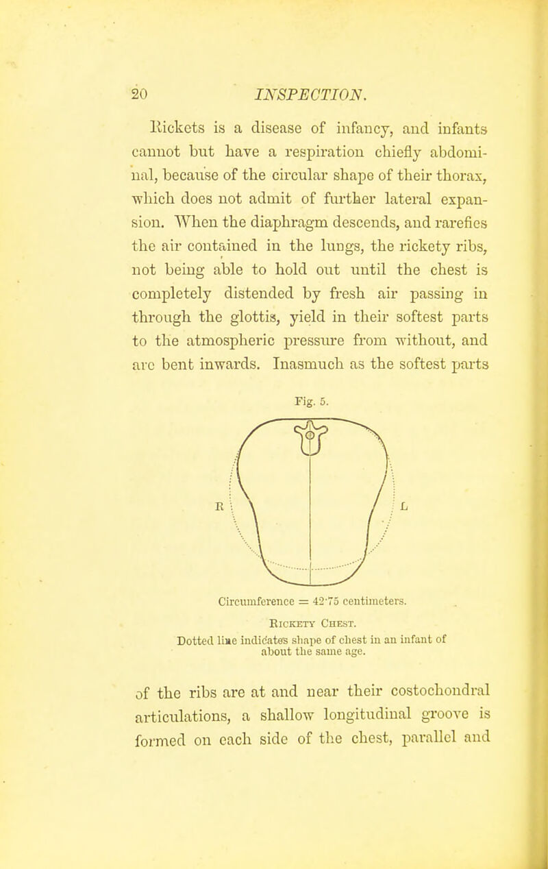 Eickets is a disease of infancy, and infants cannot but have a respiration chiefly abdomi- nal, because of the circular shape of their thorax, which does not admit of further lateral expan- sion. When the diaphragm descends, and rarefies the air contained in the lungs, the rickety ribs, not being able to hold out until the chest is completely distended by fresh air passing in through the glottis, yield in their softest parts to the atmospheric pressm*e from without, and arc bent inwards. Inasmuch as the softest parts Fig. 5. Cil'ciimference — 42'5 ceutuneters. EicKETY Chest. Dotted line indicates sliape of chest iu an infant of aljout the same age. of the ribs are at and near their costochondral articulations, a shallow longitudinal groove is formed on each side of th.e chest, parallel and