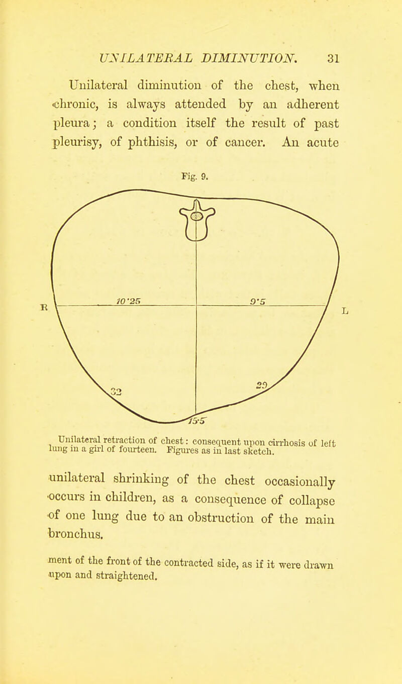 Unilateral diminution of the chest, when chronic, is always attended by an adherent pleura; a condition itself the result of past pleurisy, of phthisis, or of cancer. An acute Fig. 9. Unilateral retraction of chest: consequent upon oirrliosis of left lung in a girl of fourteen. Figui-es as in last sketch. •unilateral shrinking of the chest occasionally •occurs in children, as a consequence of collapse of one lung due to an obstruction of the main bronchus. ment of the front of the contracted side, as if it were drawn «pon and straightened.
