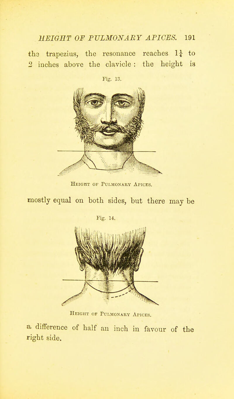 ths trapezius, the resonance reaches \\ to 2 inches above the clavicle : the height is Fig. 13. HEionx OF Pulmonary Apices. mostly equal on both sides, but there may be Fig. 14. Height of Pulmonary Apices. a difference of half an inch in favour of the right side.