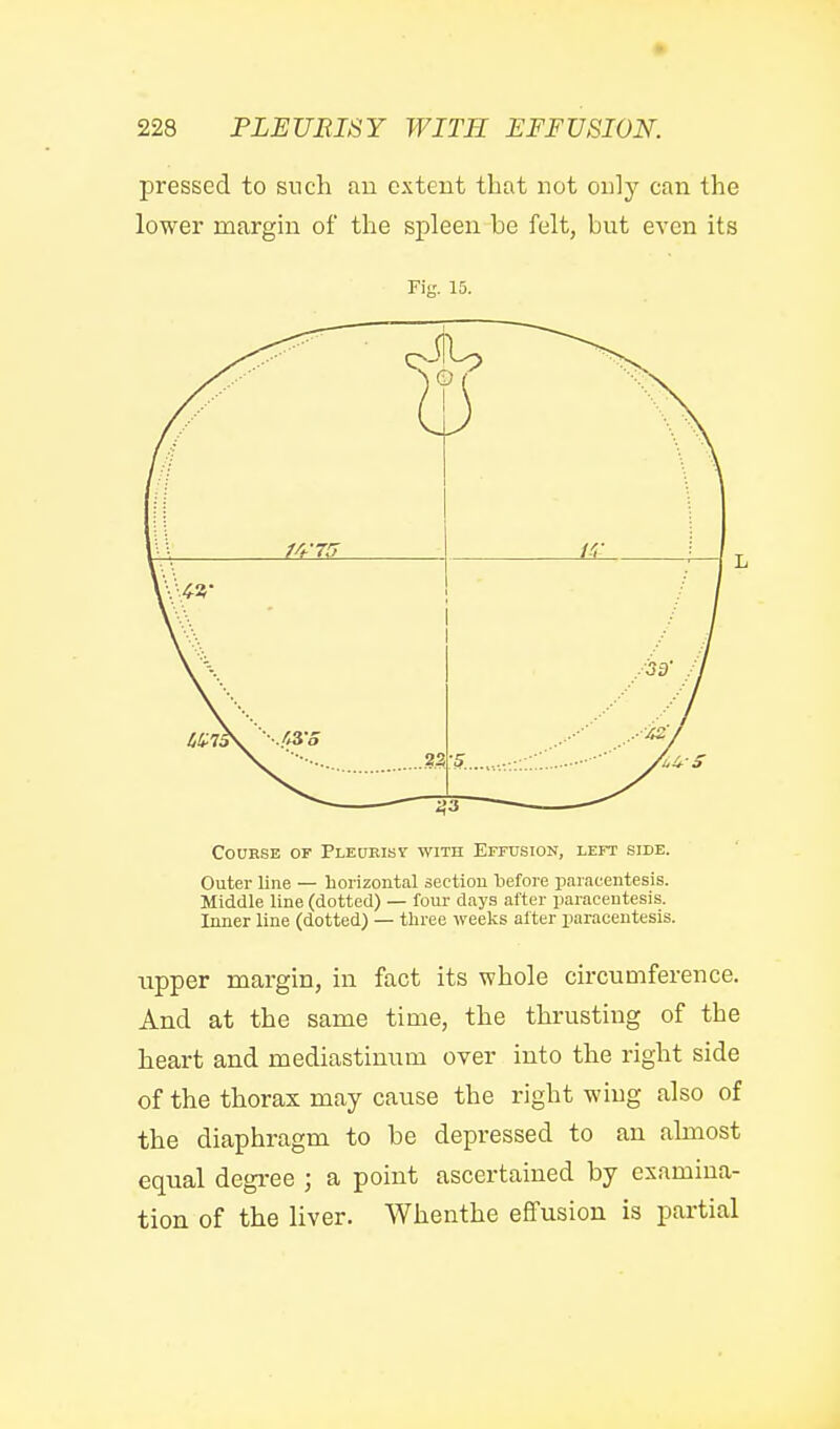 » 228 PLEURISY WITH EFFUSION. pressed to sncli an extent that not only can the lower margin of the spleen be felt, but even its Fig. 15. Course of Pleurisv with Effusiok, left side. Outer line — horizontal section before paracentesis. Middle line (dotted) — four days after paracentesis. Inner line (dotted) — three weeks after paracentesis. upper margin, in fact its whole circumference. And at the same time, the thrusting of the heart and mediastinum over into the right side of the thorax may cause the right wing also of the diaphragm to be depressed to an almost equal degi-ee ; a point ascertained by examina- tion of the liver. Whenthe effusion is partial