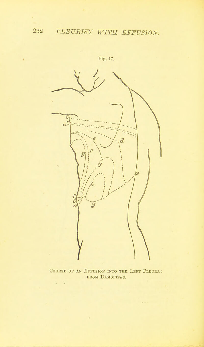 Kg. 17. Co-JRSE OF AN Effusion into the Left Pleura FKOM DaMOISEAU.