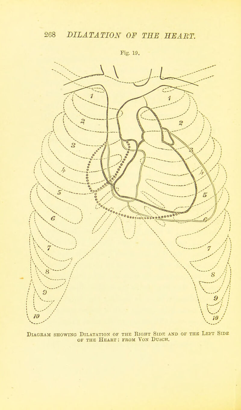 Fig. 19. Diagram showing Dilatation of the Right Side and or the Leit Side OF the Heaet : from Von Dusch.