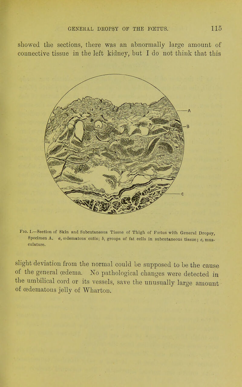 showed the sections, there was an abnormally large amount of connective tissue in the left kidney, but I do not think that this Fio. 1.—Section of Skin and Subcutaneous Tissue of Thigh of Foetus with General Dropsy, Specimen A. a, cedematous cutis; b, groups of fat cells in subcutaneous tissue; ^mus- culature. slight deviation from the normal could be supposed to be the cause of the general oedema. No pathological changes were detected in the umbilical cord or its vessels, save the unusually large amount of cedematous jelly of Wharton.