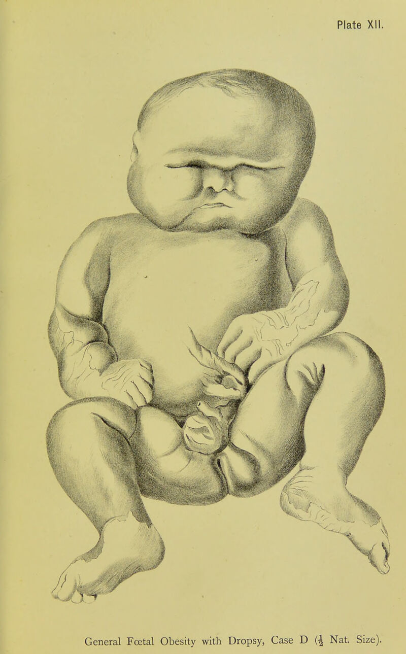 Plate XII General Foetal Obesity with Dropsy, Case D Nat. Size),