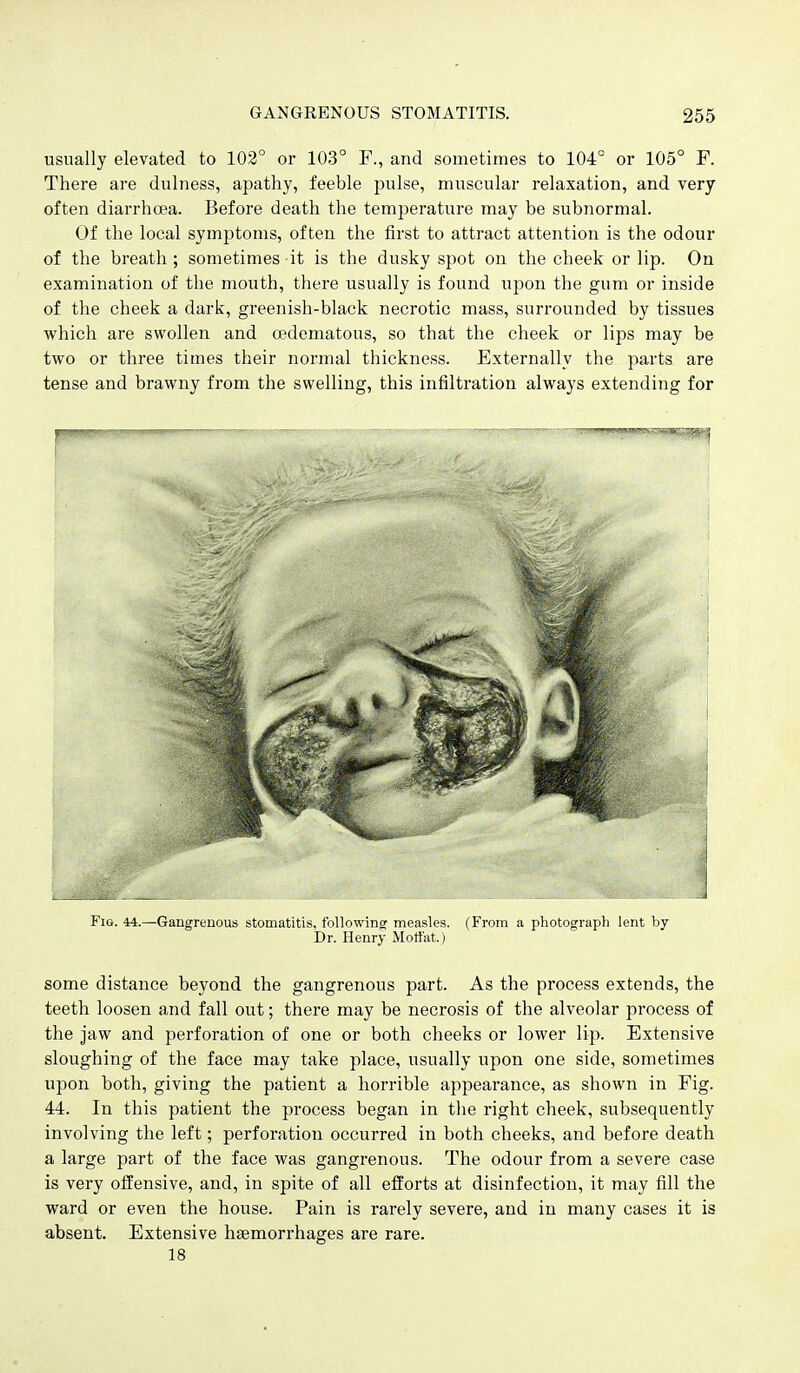 usually elevated to 102° or 103° F., and sometimes to 104° or 105° F. There are dulness, apathy, feeble pulse, muscular relaxation, and very often diarrhoea. Before death the temperature may be subnormal. Of the local symptoms, often the first to atti'act attention is the odour of the breath; sometimes it is the dusky spot on the cheek or lip. On examination of the mouth, there usually is found upon the gum or inside of the cheek a dark, greenish-black necrotic mass, surrounded by tissues which are swollen and cedematous, so that the cheek or lips may be two or three times their normal thickness. Externally the parts are tense and brawny from the swelling, this infiltration always extending for Fig. 44.—-Gangrenous stomatitis, following measles. (From a photograph lent by Dr. Henry Mottat.) some distance beyond the gangrenous part. As the process extends, the teeth loosen and fall out; there may be necrosis of the alveolar process of the jaw and perforation of one or both cheeks or lower lip. Extensive sloughing of the face may take place, usually upon one side, sometimes upon both, giving the patient a horrible appearance, as shown in Fig. 44. In this patient the process began in the right cheek, subsequently involving the left; perforation occurred in both cheeks, and before death a large part of the face was gangrenous. The odour from a severe case is very offensive, and, in spite of all efforts at disinfection, it may fill the ward or even the house. Pain is rarely severe, and in many cases it is absent. Extensive haemorrhages are rare. 18