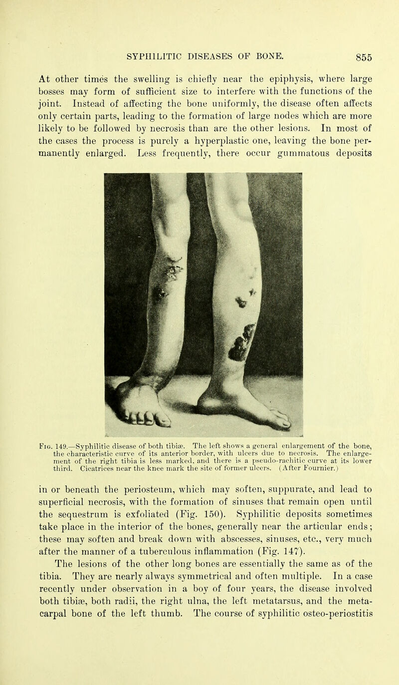 At other times the swelling is chiefly near the epiphysis, where large bosses may form of sufficient size to interfere with the functions of the joint. Instead of affecting the bone uniformly, the disease often affects only certain parts, leading to the formation of large nodes which are more likely to be followed by necrosis than are the other lesions. In most of the cases the process is purely a hyperplastic one, leaving the bone per- manently enlarged. Less frequently, there occur gummatous deposits Fig. 149.—Syphilitic disease of both tibiae. The left shows a general enlargement of the bone, the characteristic curve of its anterior border, with ulcers due to necrosis. The enlarge- ment of the right tibia is less marked, and there is a pseudo-raehitio curve at its lower third. Cicatrices near the knee mark the site of former ulcers. (After Fournier.) in or beneath the periosteum, which may soften, suppurate, and lead to superficial necrosis, with the formation of sinuses that remain open until the sequestrum is exfoliated (Fig. 150). Syphilitic deposits sometimes take place in the interior of the bones, generally near the articular ends; these may soften and break down with abscesses, sinuses, etc., very much after the manner of a tuberculous inflammation (Fig. 147). The lesions of the other long bones are essentially the same as of the tibia. They are nearly always symmetrical and often multiple. In a case recently under observation in a boy of four years, the disease involved both tibiae, both radii, the right ulna, the left metatarsus, and the meta- carpal bone of the left thumb. The course of syphilitic osteo-periostitis