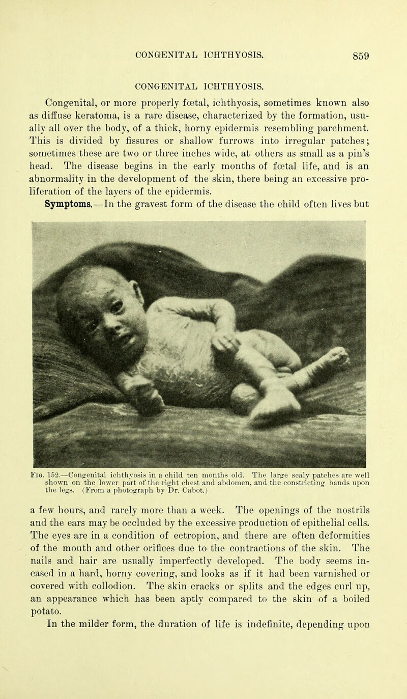 CONGENITAL ICHTHYOSIS. Congenital, or more properly foetal, ichthyosis, sometimes known also as diffuse keratoma, is a rare disease, characterized by the formation, usu- ally all over the body, of a thick, horny epidermis resembling parchment. This is divided by fissures or shallow furrows into irregular patches; sometimes these are two or three inches wide, at others as small as a pin's head. The disease begins in the early months of foetal life, and is an abnormality in the development of the skin, there being an excessive pro- liferation of the layers of the epidermis. Symptoms.—In the gravest form of the disease the child often lives but Fio. 152.—Congenital iciithyosis in a child ten months old. Tlie large scaly patches are well shown on the lower part of the riffht chest and abdomen, and the constricting bands upon the legs. (From a photograph by Dr. Cabot.) a few hours, and rarely more than a week. The openings of the nostrils and the ears may be occluded by the excessive production of epithelial cells. The eyes are in a condition of ectropion, and there are often deformities of the mouth and other orifices due to the contractions of the skin. The nails and hair are usually imperfectly developed. The body seems in- cased in a hard, horny covering, and looks as if it had been varnished or covered with collodion. The skin cracks or splits and the edges curl up, an appearance which has been aptly compared to the skin of a boiled potato. In the milder form, the duration of life is indefinite, depending upon