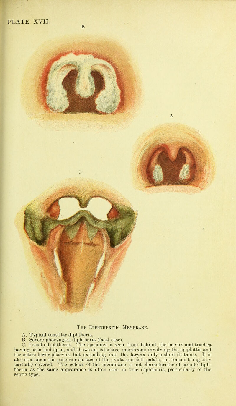 PLATE XVII. B This Diphtheritic Membrane. A. Typical tonsillar diphtheria. B. Severe pharyngeal diphtheria (fatal case). C. Pseudo-diphtheria. The specimen is seen from behind, the larynx and trachea having been laid open, and shows an extensive membrane involving the epiglottis and the entire lower pharynx, but extending into the larynx only a short distance. It is also seen upon the posterior surface of the uvula and soft palate, the tonsils being only partially covered. The colour of the membrane is not characteristic of pseudo-diph- theria, as the same appearance is often seen in true diphtheria, particularly of the septic type.