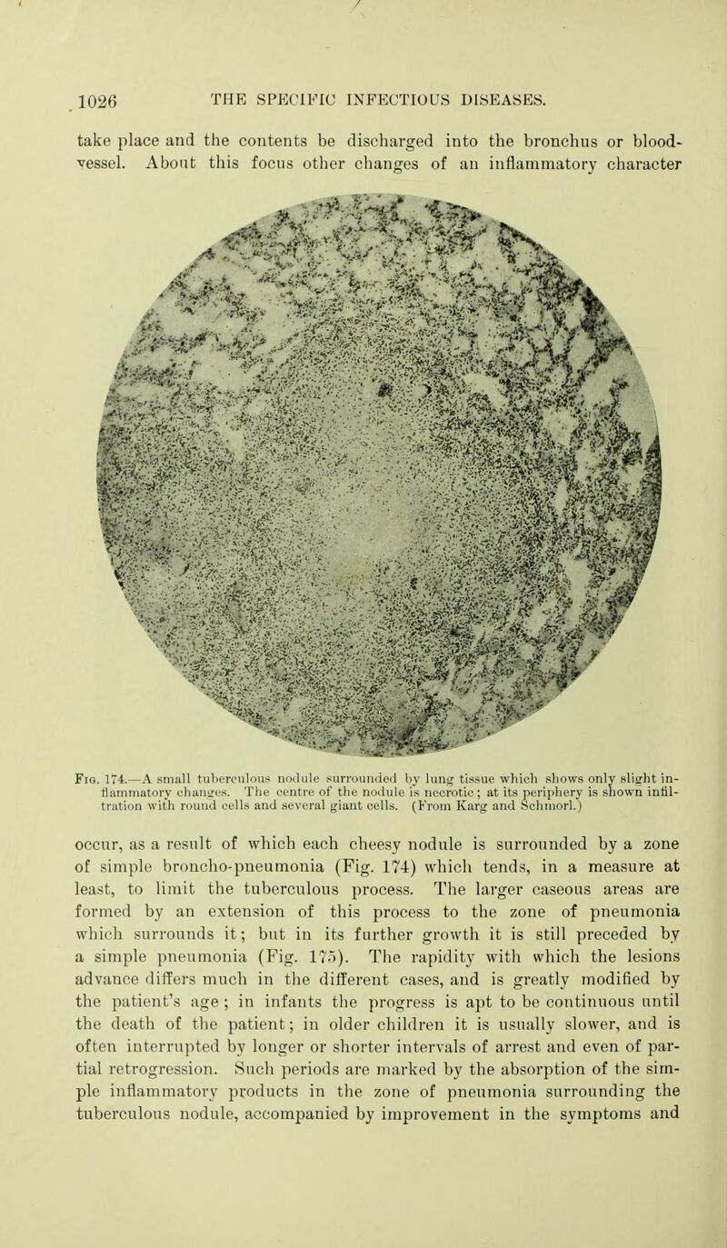 / 1026 THE SPECIFIC INFECTIOUS DISEASES. take place and the contents be discharged into the bronchus or blood- vessel. About this focus other changes of an inflammatory character Fio. 174.—A small tuberculous nodule surrounded by lung tissue which shows only slight in- tiamniatory changes. The centre of the nodule is necrotic; at its periphery is shown inlil- tration with round cells and several giant cells. (From Karg and Schmorl.) occur, as a result of which each cheesy nodule is surrounded by a zone of simple broncho-pneumonia (Fig. 174) which tends, in a measure at least, to limit the tuberculous process. The larger caseous areas are formed by an extension of this process to the zone of pneumonia which surrounds it; but in its further growth it is still preceded by a simple pneumonia (Fig. 175). The rapidity with which the lesions advance diifers much in the different cases, and is greatly modified by the patient's age ; in infants the progress is apt to be continuous until the death of the patient; in older children it is usually slower, and is often interrupted by longer or shorter intervals of arrest and even of par- tial retrogression. Such periods are marked by the absorption of the sim- ple inflammatory products in the zone of pneumonia surrounding the tuberculous nodule, accompanied by improvement in the symptoms and