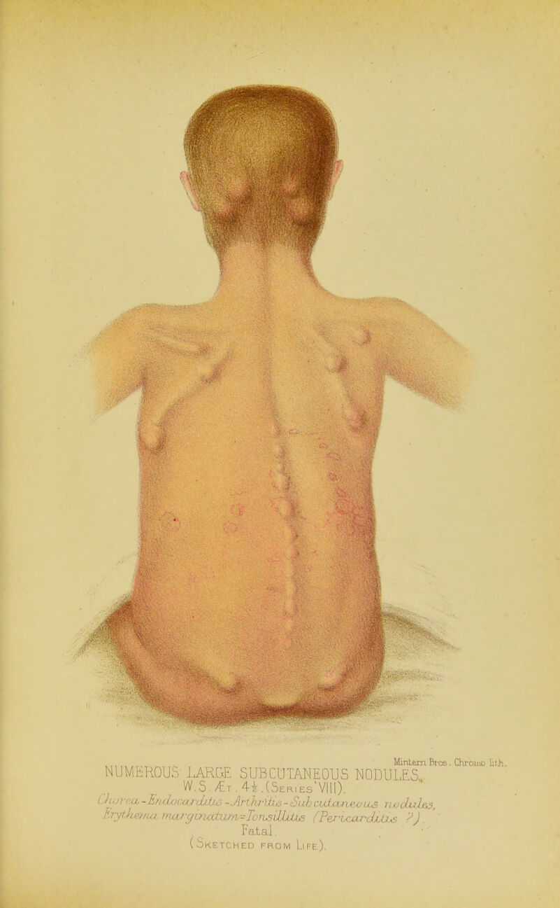 NUMfcROUS- lARGE SUBCUTANEOUS NOnULES. W.5.^T.4i.(SER,Es'Vlll). Uwrca-Endxxxx/cluU^ -Arth-ibis-SuhaMxJurLeoLLS nodules, E7yke.f/m.Truuyirudani=TowiRdAjS (PeruLox^djuLhs ?).' Fatal. (Sketched from Life).