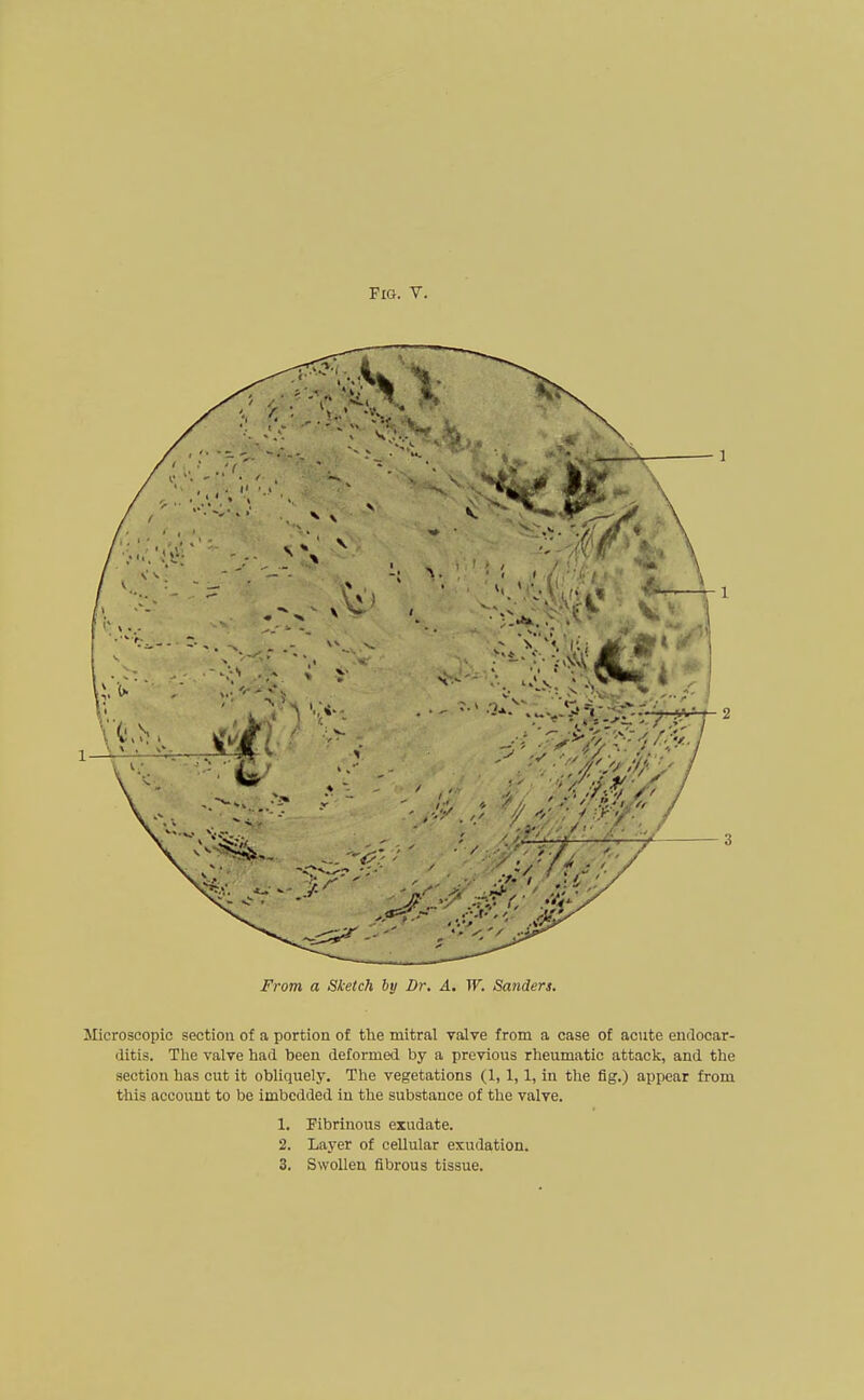 From a Sketch hy Dr. A. W. Sanders. Microscopic section of a portion of the mitral valve from a case of aoite endocar- ditis. The valve had been deformed by a previous rheumatic attack, and the section has cut it obliquely. The vegetations (1, 1,1, in the fig.) appear from this account to be imbedded in the substance of the valve. 1. Fibrinous exudate. 2. Layer of cellular exudation. 3. Swollen fibrous tissue.