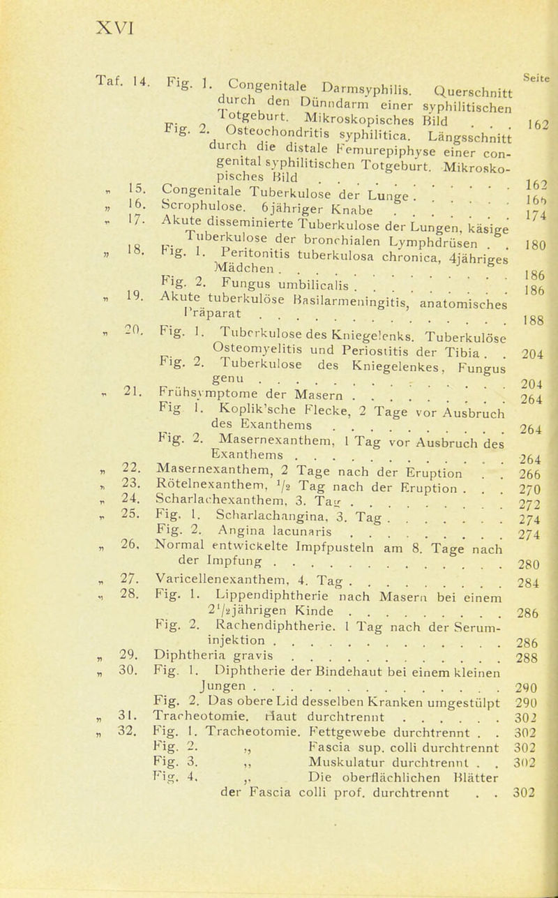 Taf. U. Fig. 1 Congenitale Darrnsyphili, Querschnitt ^ durch den Dünndarm einer syphilitischen lotgeburt. Mikroskopisches Bild i62 Fig. 2 Osteochondritis syphilitica. Längsschnitt durch die distale Femurepiphyse einer con- genital syphilitischen Totgeburt. Mikrosko- pisches Bild 15. Congenitale Tuberkulose der Lunge '. ' ' ]tl 6. Scrophulose. 6jähriger Knabe ' 7? 17. Akute disseminierte Tuberkulose der Lungen, käsige 19. 18 P T!lberDkulose der bronchialen Lymphdrüsen . Fig. 1. Peritonitis tuberkulosa chronica, 4iähriges Mädchen J ige Fig. 2. Fungus umbilicalis . . . . jg6 Akute tuberkulöse Hasilarmeningitis, anatomisches I raparat ]gg 20. Fig. 1. Tuberkulose des Kniegelenks. Tuberkulöse Osteomyelitis und Periostitis der Tibia . . 204 Fig. 2. Tuberkulose des Kniegelenkes, Fungus genu r . . . 204 21. Frühsymptome der Masern 264 Fig 1. Koplik'sche Flecke, 2 Tage vor Ausbruch des Exanthems 264 Fig. 2. Masernexanthem, 1 Tag vor Ausbruch des Exanthems 264 22. Masernexanthem, 2 Tage nach der Eruption . .' 266 23. Rötelnexanthem, J/2 Tag nach der Eruption ... 2/0 24. Scharlachexanthem, 3. Tair 272 25. Fig. 1. Scharlachangina, 3. Tag ....... 274, Fig. 2. Angina lacunaris 2/4 26. Normal entwickelte Impfpusteln am 8. Tage nach der Impfung 280 27. Varicellenexanthem, 4. Tag 284 28. Fig. 1. Lippendiphtherie nach Masern bei einem 2'/ajährigen Kinde 286 Fig. 2. Rachendiphtherie. 1 Tag nach der Serum- injektion 286 29. Diphtheria gravis 288 30. Fig. 1. Diphtherie der Bindehaut bei einem kleinen Jungen 290 Fig. 2. Das obere Lid desselben Kranken umgestülpt 290 31. Trarheotomie. Haut durchtrennt 302 32. Fig. 1. Tracheotomie. Fettgewebe durchtrennt . . 302 Fig. 2. „ Fascia sup. colli durchtrennt 302 Fig. 3. ,, Muskulatur durchtrennt . . 302 Fig. 4. Die oberflächlichen Blätter der Fascia colli prof. durchtrennt . . 302