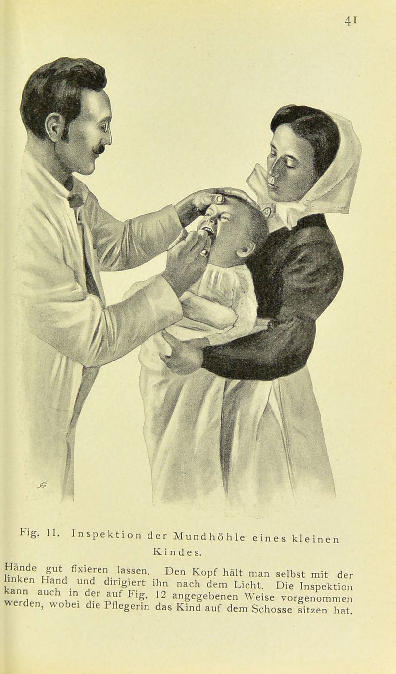 V \ i 1$ I I Fig. 11. Inspektion der Mundhöhle eines kleinen Kindes. Mn?.^ HgUt, ßXiefenJ. l3SSen- Den K°Pf hält man s^st mit der hnken Hand und dirigiert ihn nach dem Licht. Die Inspektion werl k rr ™f FIg- 12 angege^nen Weise vorgenommen werden, wobei die Pflegerin das Kind auf dem Schosse sitzen hat