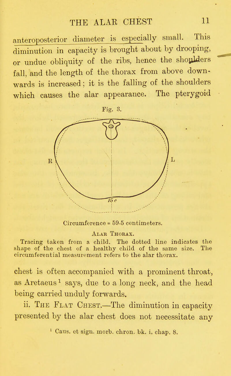anteroposterior diameter is especially small. This diminution in capacity is brought about by drooping, or undue obliquity of the ribs, hence the shoyWers fall, and the length of the thorax from above down- wards is increased; it is the falling of the shoulders which causes the alar appearance. The pterygoid Fig. 3. Circumference = 59-5 centimeters. Alar Thorax. Tracing taken from a child. The dotted line indicates tlie shape of the chest of a healthy child of the same size. The circumferential measurement refers to the alar thorax. chest is often accompanied with a prominent throat, as Aretaeus ^ says, due to a long neck, and the head being carried unduly forwards. ii. The Fla.t Chest.—The diminution in capacity presented by the alar chest does not necessitate any ' Cans, et sign. morb. chron. bk. i. chap. 8.