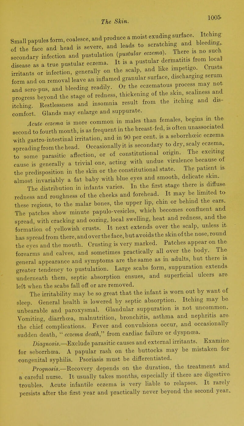 1005- Small papules form, coalesce, and produce a m xst ^--f-^^f^l' ^^^^ of the face and head is severe, and leads to ^^'^'^^^.^ -.n^^^^ Lcondary infection and pustulation {vustular eczema) There is no uch S se as a true pustular eczema. It is a P-^ul- f — rom o^^ irritants or mfection, generally on the scalp and hke -P^t^^^^^^^^ form and on removal leave an inflamed granular surface, dischargmg seruni and sero pus, and bleeding readily. Or the eczematous process may not pi ess bey;nd the stage of redness, thickening of the skm scalmess and Restlessness aid insomnia result from the itchmg and dis- comfort. Glands may enlarge and suppurate. Acute eczema is more common in males than females, begins m the second to fourth month, is as frequent in the breast-fed, is often unassociated with .astro-intestinal irritation, and in 90 per cent, is a seborrhc^ic eczema spreadingfromthehead. Occasionally it is secondary to dry, scaly eczema, to some parasitic afiectxon, or of constitutional ongm The excitmg cause is generally a trivial one, acting with undue virulence because of the predisposition in the skin or the constitutional state. The patient is almost invariably a fat baby with blue eyes and smooth, delicate skm. The distribution in infants varies. In the first stage there is difiuse redness and roughness of the cheeks and forehead. It may be limited to these regions, to the malar bones, the upper lip, chin or behmd the ears The patches show minute papulo-vesicles, which becomes confluent and spread, with cracking and oozing, local swelling, heat and redness, and the formation of yellowish crusts. It next extends over the scalp, unless it. has spreadfrom there, and over the face, but avoids the skin of the nose,round the eves and the mouth. Crusting is very marked. Patches appear on the forearms and calves, and sometimes practically all over the body. The general appearance and symptoms are the same as in adults, but there is. greater tendency to pustulation. Large scabs form, suppuration extends, underneath them, septic absorption ensues, and superficial ulcers are left when the scabs fall off or are removed. The irritability may be so great that the infant is worn out by want of sleep. General health is lowered by septic absorption. Itching may be- unbearable and paroxysmal. Glandular suppuration is not uncommon. Vomiting, diarrhcEa, malnutrition, bronchitis, asthma and nephritis are the chief complications. Fever and convulsions occur, and occasionally sudden death, eczema death;' from cardiac failure or dyspnoea. Diagnosis.—Exclude parasitic causes and external irritants. Examine for seborrhoea. A papular rash on the buttocks may be mistaken for congenital syphilis. Psoriasis must be differentiated. Prognosis.—'Recowexj depends on the duration, the treatment and a careful nurse. It usually takes months, especially if there are digestive troubles. Acute infantile eczema is very liable to relapses. It rarely persists after the first year and practically never beyond the second year.