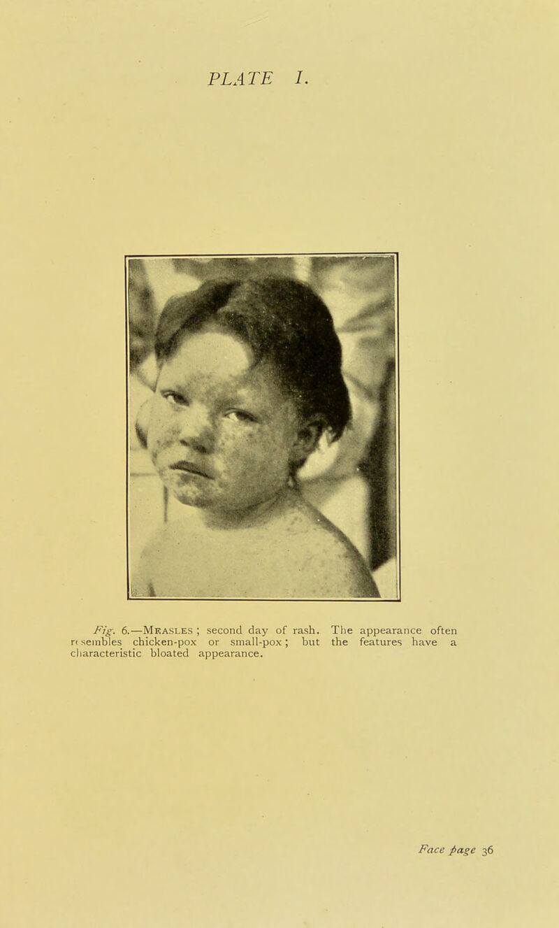 PLATE 1. Fig. 6.—Mkasles ; second day of rash. The appearance often r< seinbles chicken-pox or small-pox; but the features have a characteristic bloated appearance. Face page