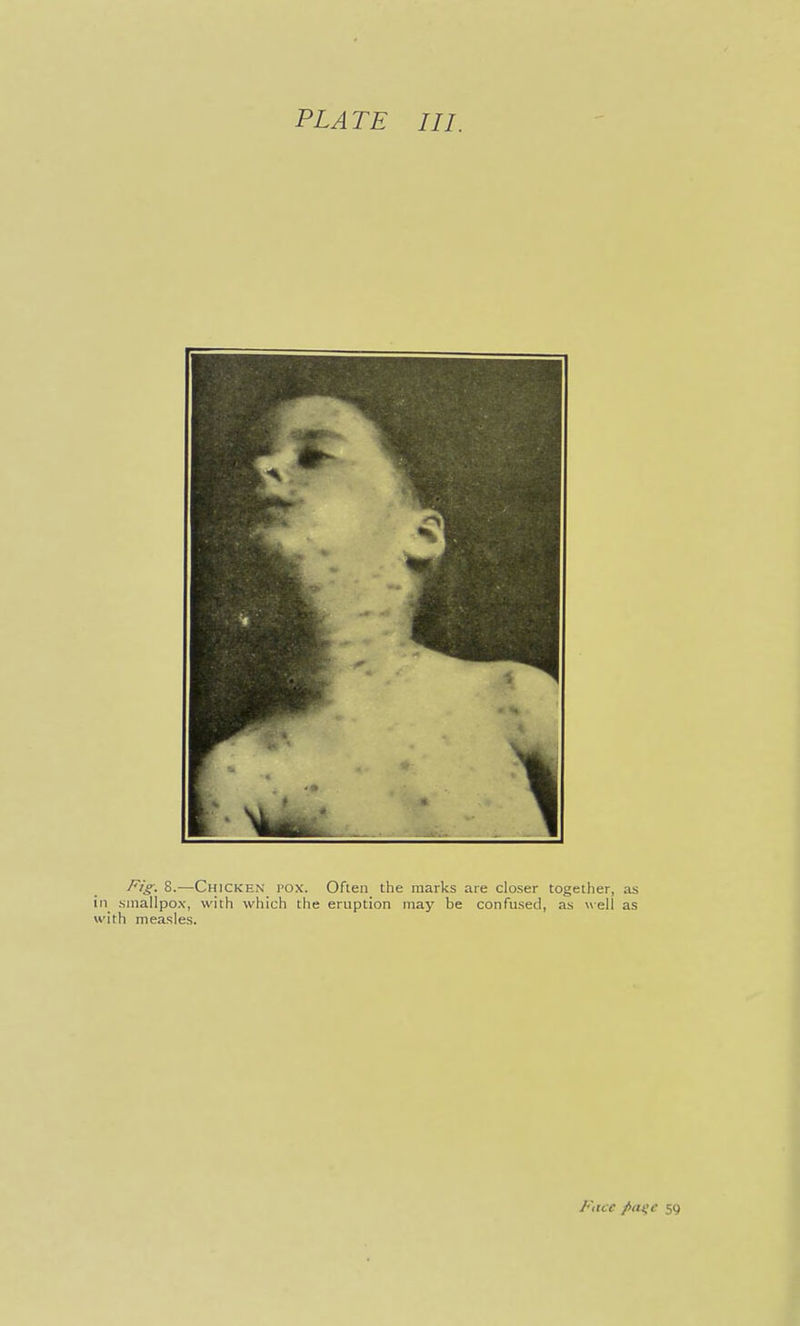 PLATE III. Fig. 8.—Chicken pox. Often the marks are closer together, as in smallpox, with which the eruption may be confused, as well as with measles. Face pti^c