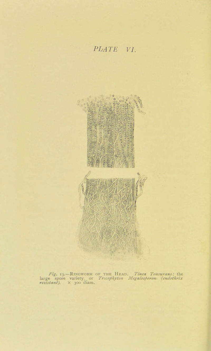 Fig. 13-—Ringworm of the Head. Tinea Tonswans: the large spore variety, or Tricophytoii Megalosporon^ {cndothrix resistant). X 300 cliam.