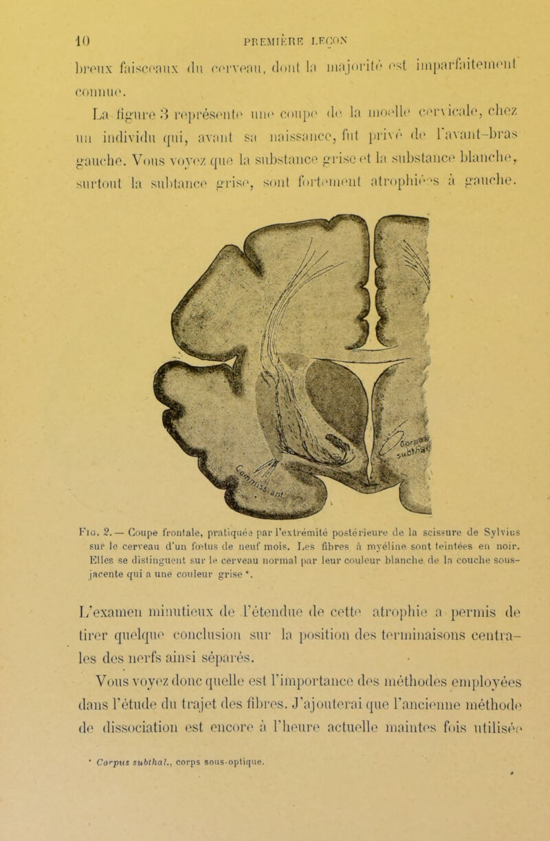 ])reux faisceaux du cerveau, dont la majorité est imparfaitement connuo. La ligure 3 représente une coupe do la moelle cervicale, chez un individu qui, avant sa naissance, fut prive de 1 avant-bras gauche. Vous voyez que la substance g rise et la substance blanche, surtout la subtance grise, sont fortement atrophie >s a gauche. Fig. 2.— Coupe frontale, pratiquée par l’extrémité postérieure de la scissure de Sylvius sur le cerveau d'un fœtus de neuf mois. Les libres à myéline sont teintées en noir. Elles se distinguent sur le cerveau normal par leur couleur blanche de la couche sous- jacente qui a une couleur grise *. L’examen minutieux de l'étendue de cette atrophie a permis de tirer quelque conclusion sur la position des terminaisons centra- les des nerfs ainsi séparés. Vous voyez donc quelle est l'importance des méthodes employées dans l’étude du trajet des fibres. J'ajouterai que l'ancienne méthode de dissociation est encore à l'heure actuelle maintes fois utilisée * Corpus subthal., corps sous-optique.