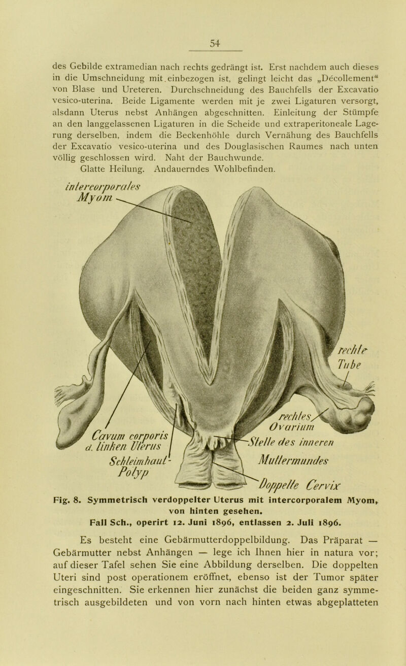 des Gebilde extramediaii nach rechts gedrängt ist. Erst nachdem auch dieses in die Umschiieidung mit. einbezogen ist, gelingt leicht das „Decollement“ von Blase und Ureteren. Durchschneidung des Bauchfells der Excavatio vesico-uterina. Beide Ligamente werden mit je zwei Ligaturen versorgt, alsdann Uterus nebst Anhängen abgeschnitten, Einleitung der Stümpfe an den langgelassenen Ligaturen in die Scheide und extraperitoneale Lage- rung derselben, indem die Beckenhöhle durch Vernähung des Bauchfells der Excavatio vesico-uterina und des Douglasischen Raumes nach unten völlig geschlossen wird. Naht der Bauchwunde. Glatte Heilung. Andauerndes Wohlbefinden. Cavum corporis d. Unheil Uleriis intercorporales Myom rechir Tube rechtes Ov avium ^ Sielte des inneren Schleimhaul- Polyp Muttermundes Poppet/e Cervix Fig. 8. Symmetrisch verdoppelter Uterus mit intercorporalem Myom, von hinten gesehen, Pall Sch., operirt 12. Juni 1896, entlassen 2. Juli 1896. Es besteht eine Gebärmutterdoppelbildung. Das Präparat — Gebärmutter nebst Anhängen — lege ich Ihnen hier in natura vor; auf dieser Tafel sehen Sie eine Abbildung derselben. Die doppelten Uteri sind post Operationen! eröffnet, ebenso ist der Tumor später eingeschnitten. Sie erkennen hier zunächst die beiden ganz symme- trisch ausgebildeten und von vorn nach hinten etwas abgeplatteten