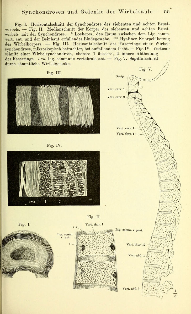 Fig. I. Horizontalschnitt der Synchondrose des siebenten und achten Brust- wirbels. — Fig. II. Medianschnitt der Körper des siebenten und achten Brust- wirbels mit der Synchondrose. * Lockeres, den Raum zwischen dem Lig. comm. vert. ant. und der Beinhaut erfüllendes Bindegewebe. Hyaliner Knorpelüberzug des Wirbelkörpers. — Fig. III. Horizontalschnitt des Faserrings einer Wirbel- synchondrose, mikroskopisch betrachtet, bei auffallendem Licht. — Fig. IV. Vertical- schnitt einer Wirbelsynchondrose, ebenso; 1 äussere, 2 innere Abtheilung des Faserrings, cva Lig. commune vertebrale ant. — Fig. V. Sagittalschnitt Fig. II. Fiff. I. Vert. thor. 7 A'ttÄtV- comm. V. post.